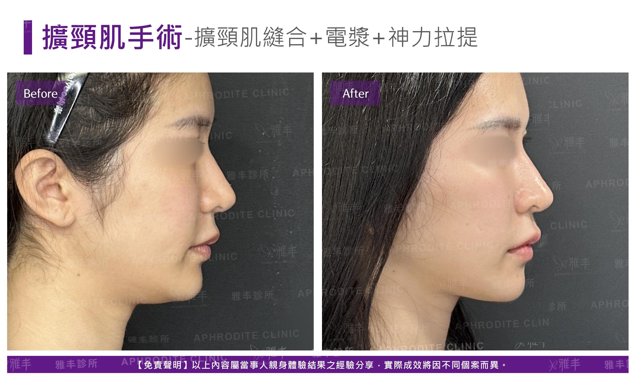 闊頸肌縫合-case4-R90.jpg