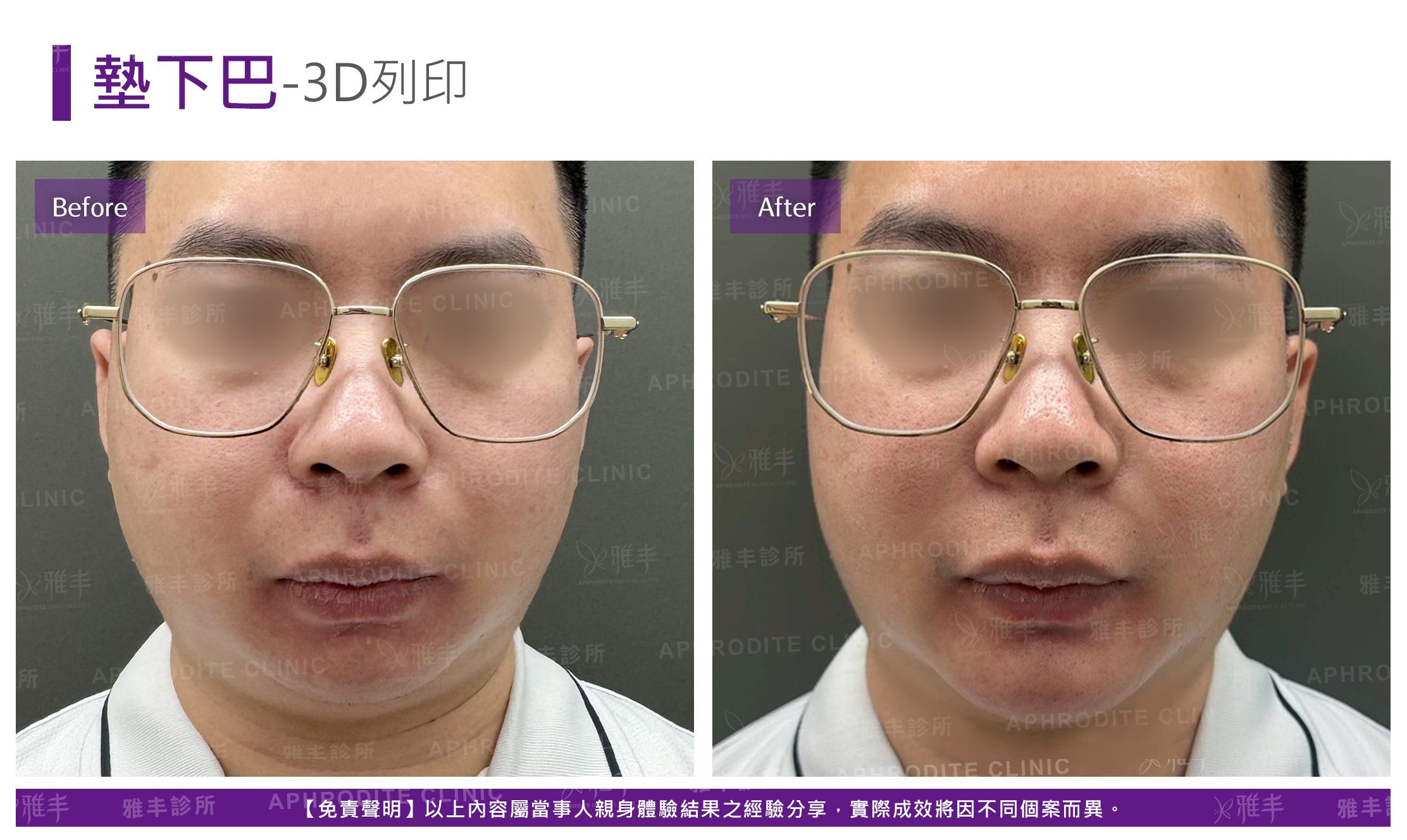3D列印下巴-case2-F.jpg