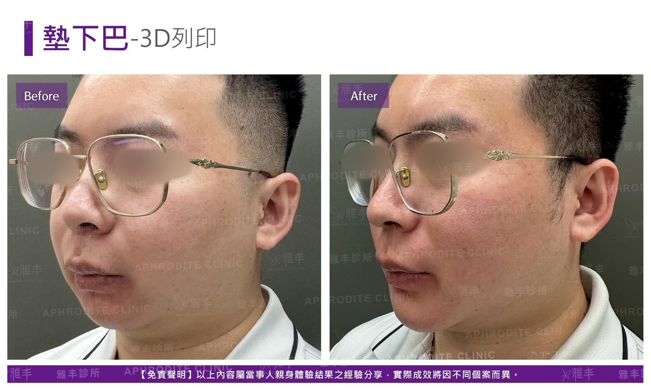 3D列印下巴-case2-L45.jpg