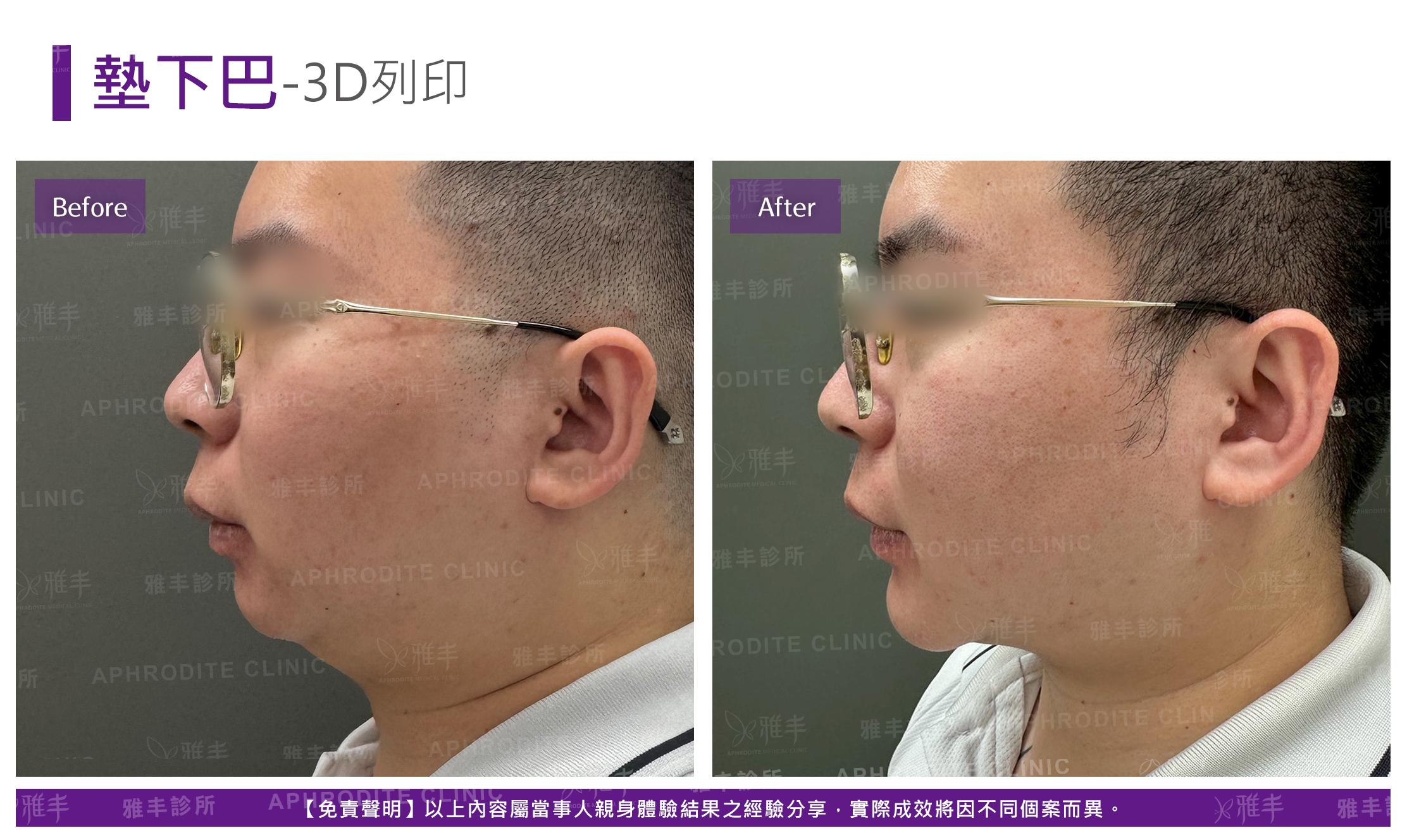 3D列印下巴-case2-L90.jpg