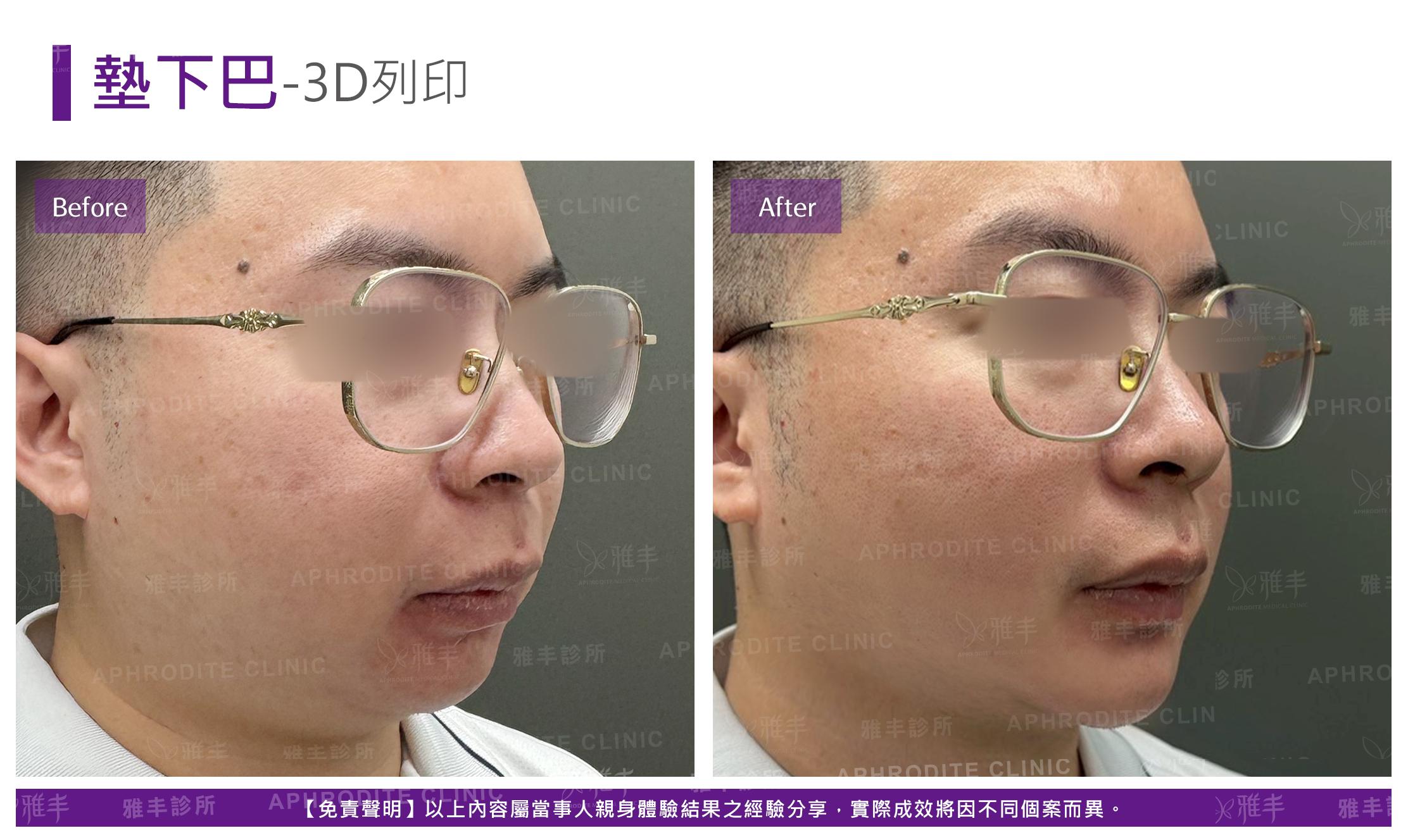 3D列印下巴-case2-R45.jpg