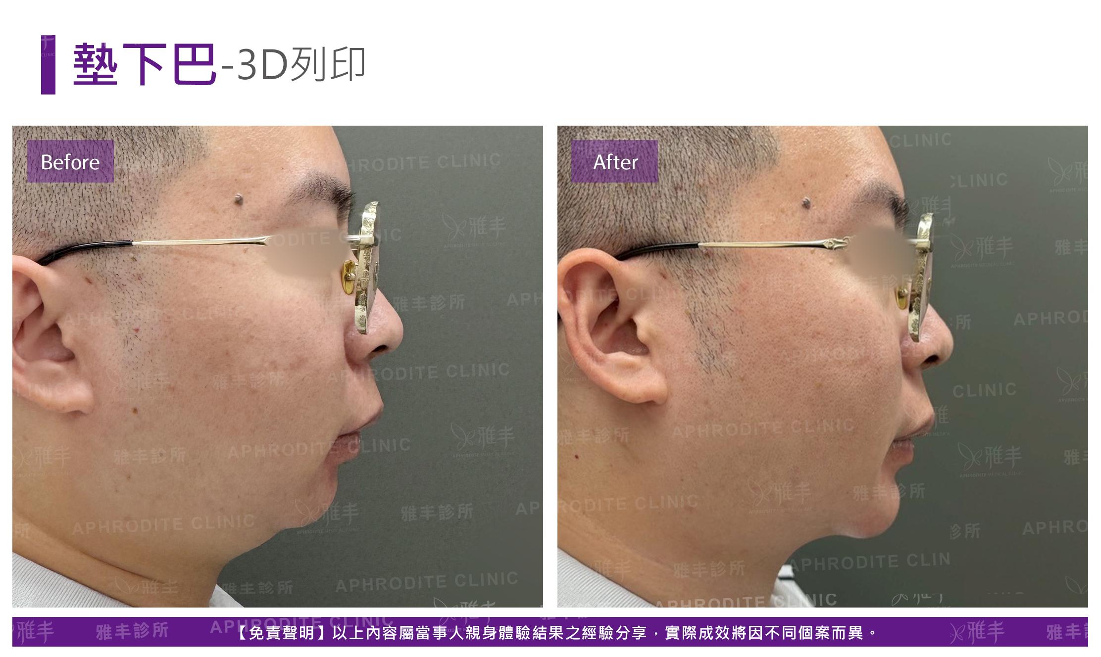 3D列印下巴-case2-R90.jpg