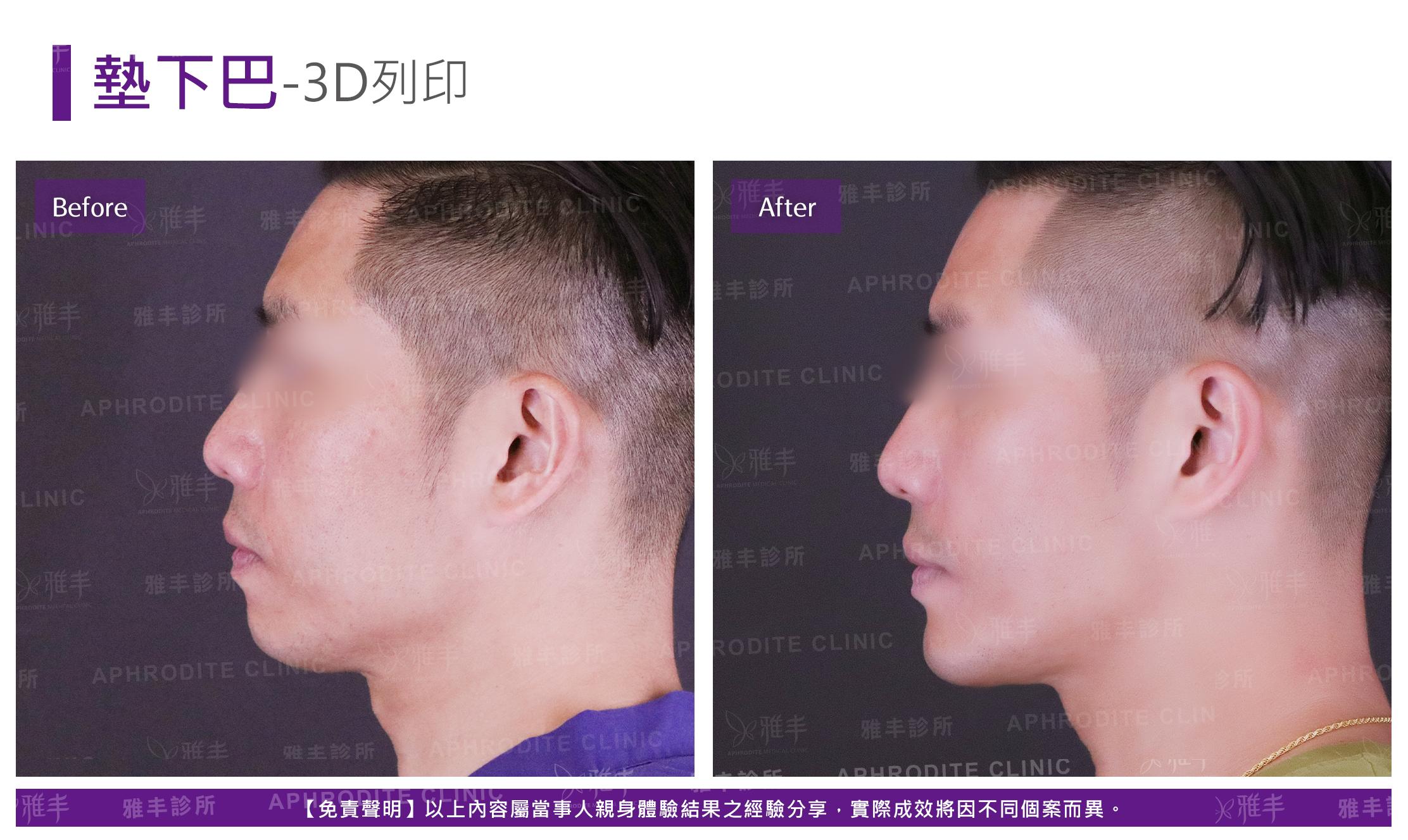 3D列印下巴-case3-L90.jpg