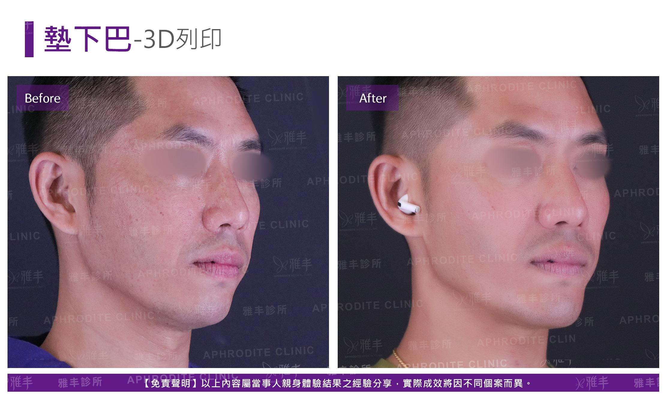 3D列印下巴-case3-R45.jpg