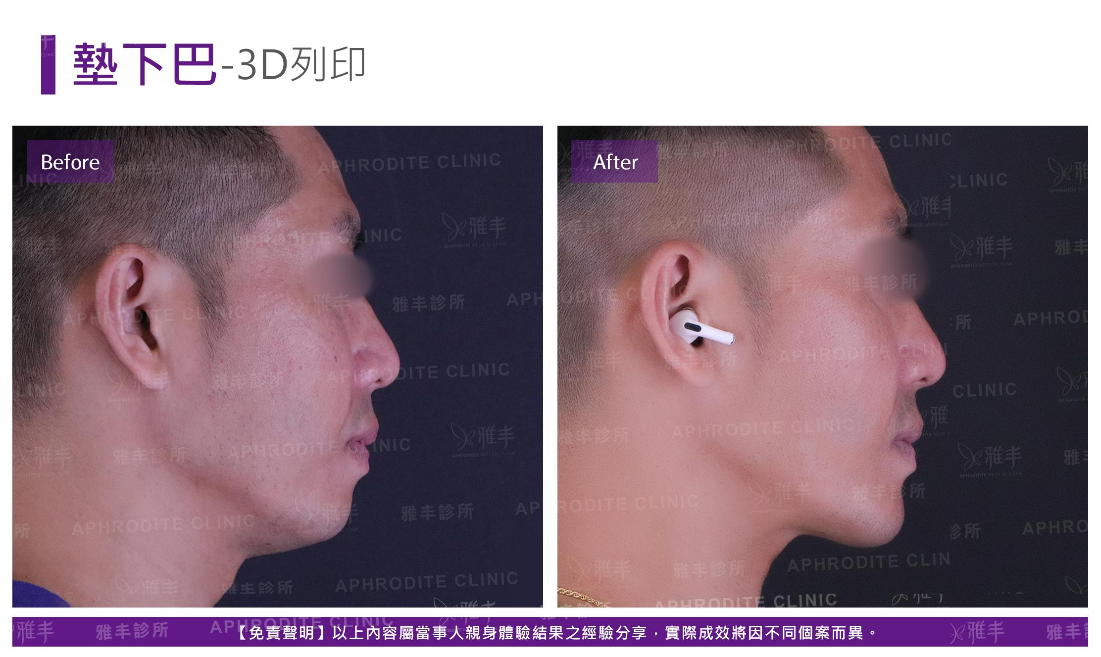 3D列印下巴-case3-R90.jpg