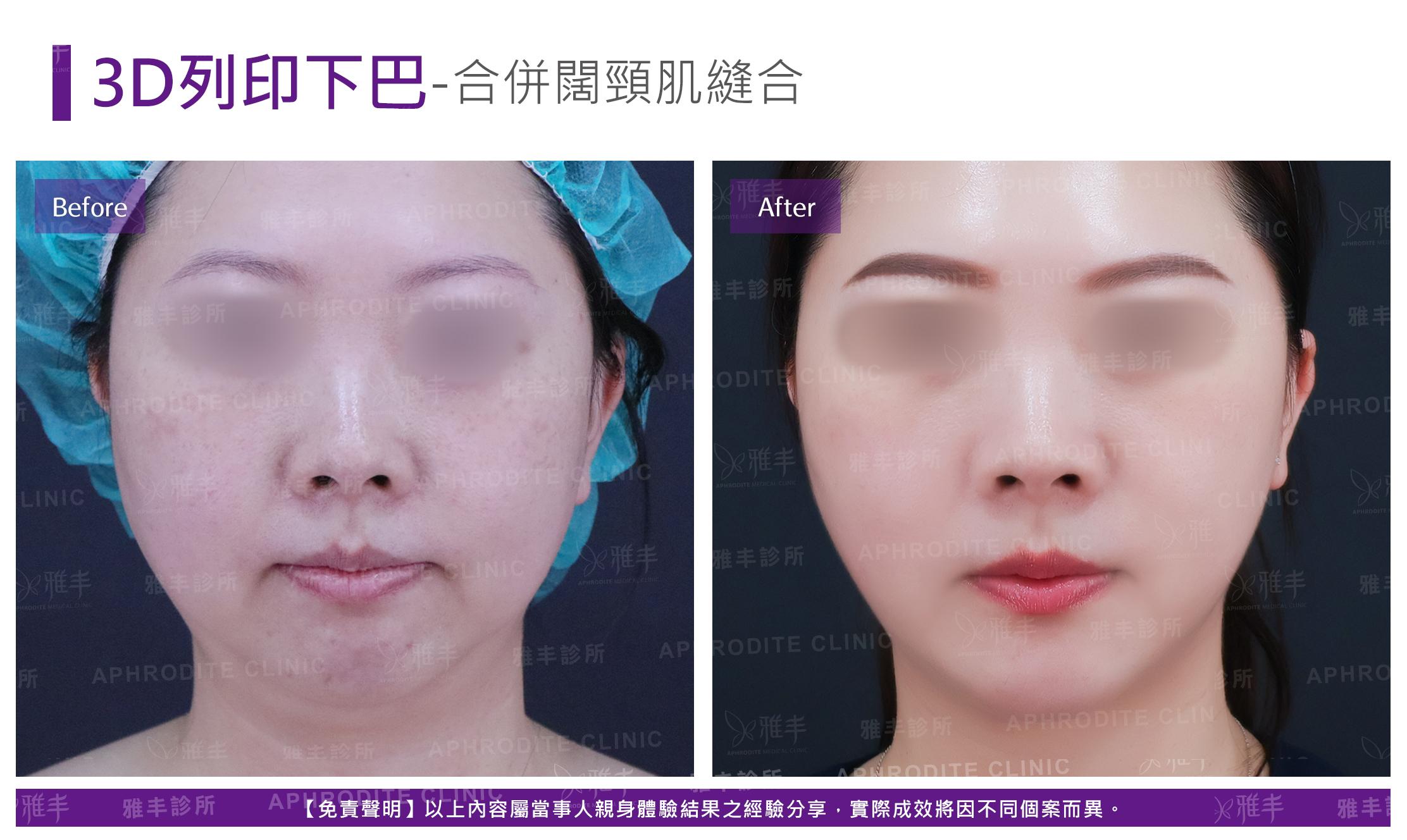 3D列印下巴-case4-F-2.jpg