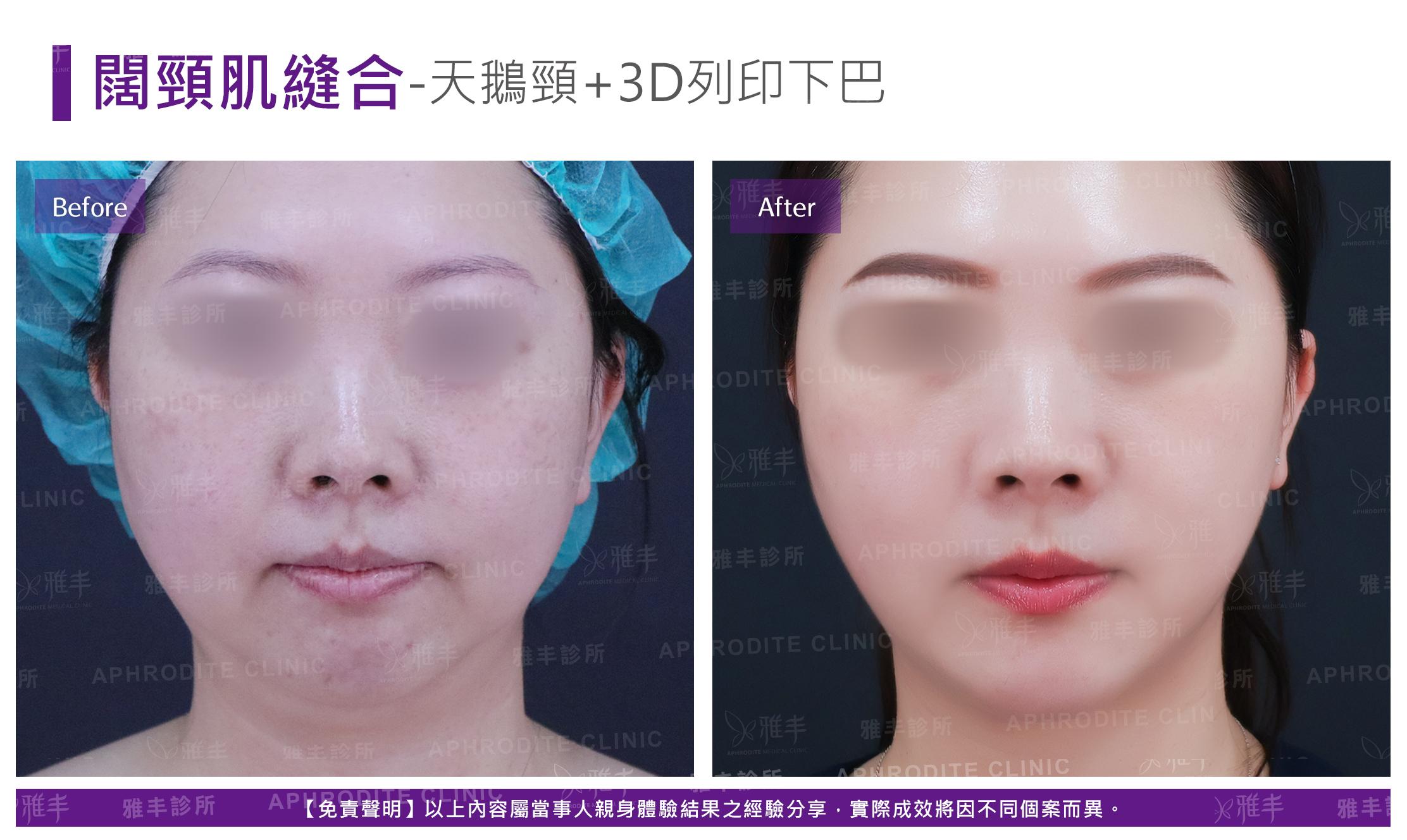 闊頸肌縫合-case4-F.jpg
