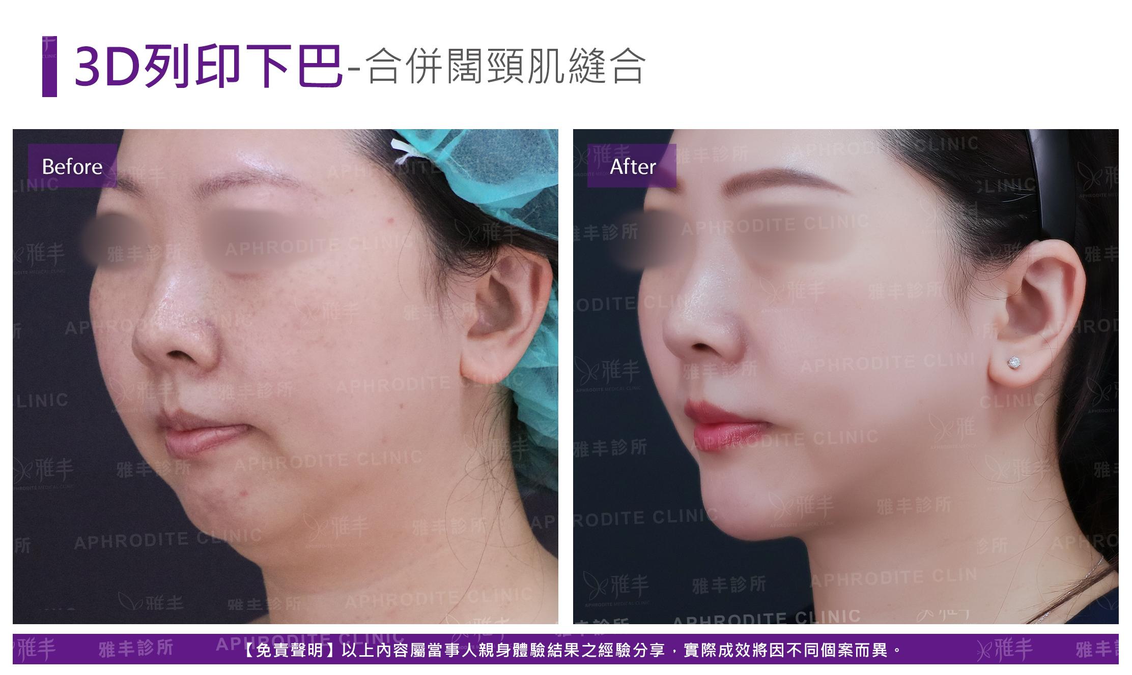 3D列印下巴-case4-L45-2.jpg