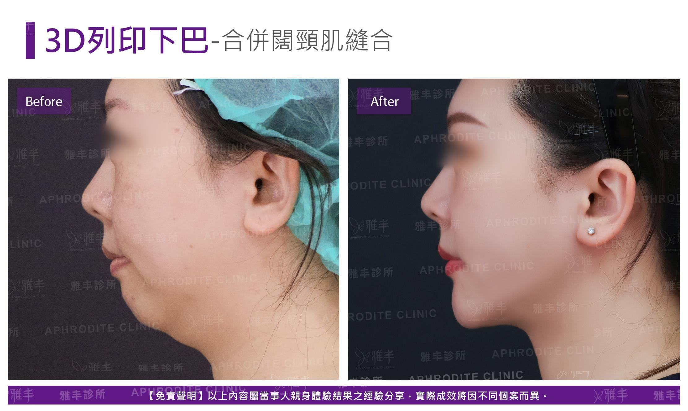 3D列印下巴-case4-L90-2.jpg