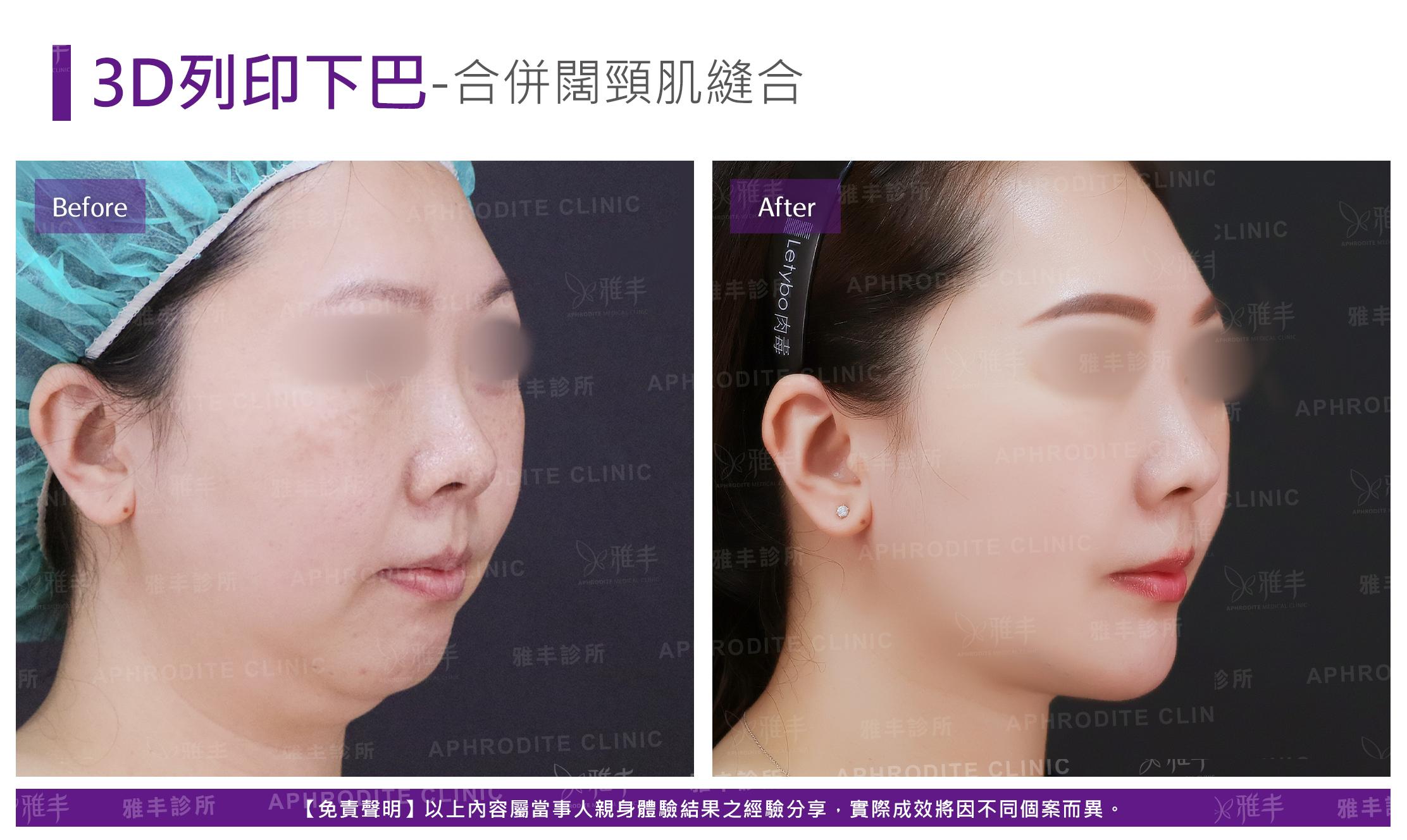 3D列印下巴-case4-R45-2.jpg