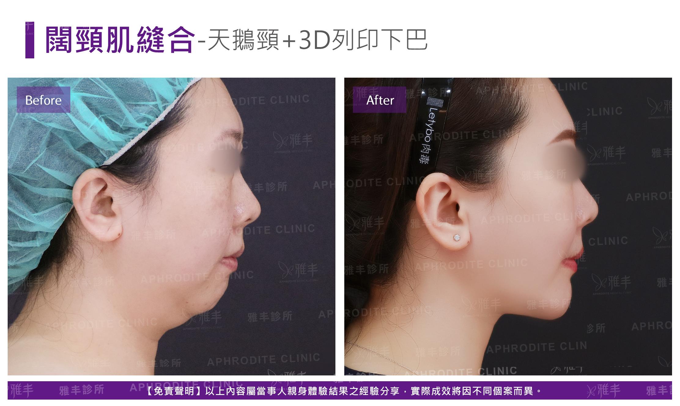 闊頸肌縫合-case4-R90.jpg