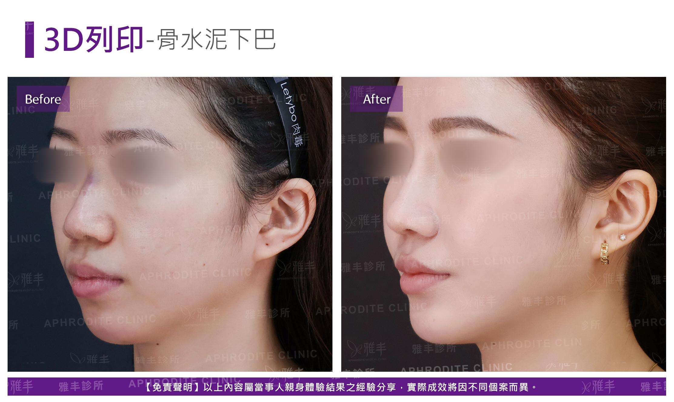 下巴手術-case5-L45.jpg