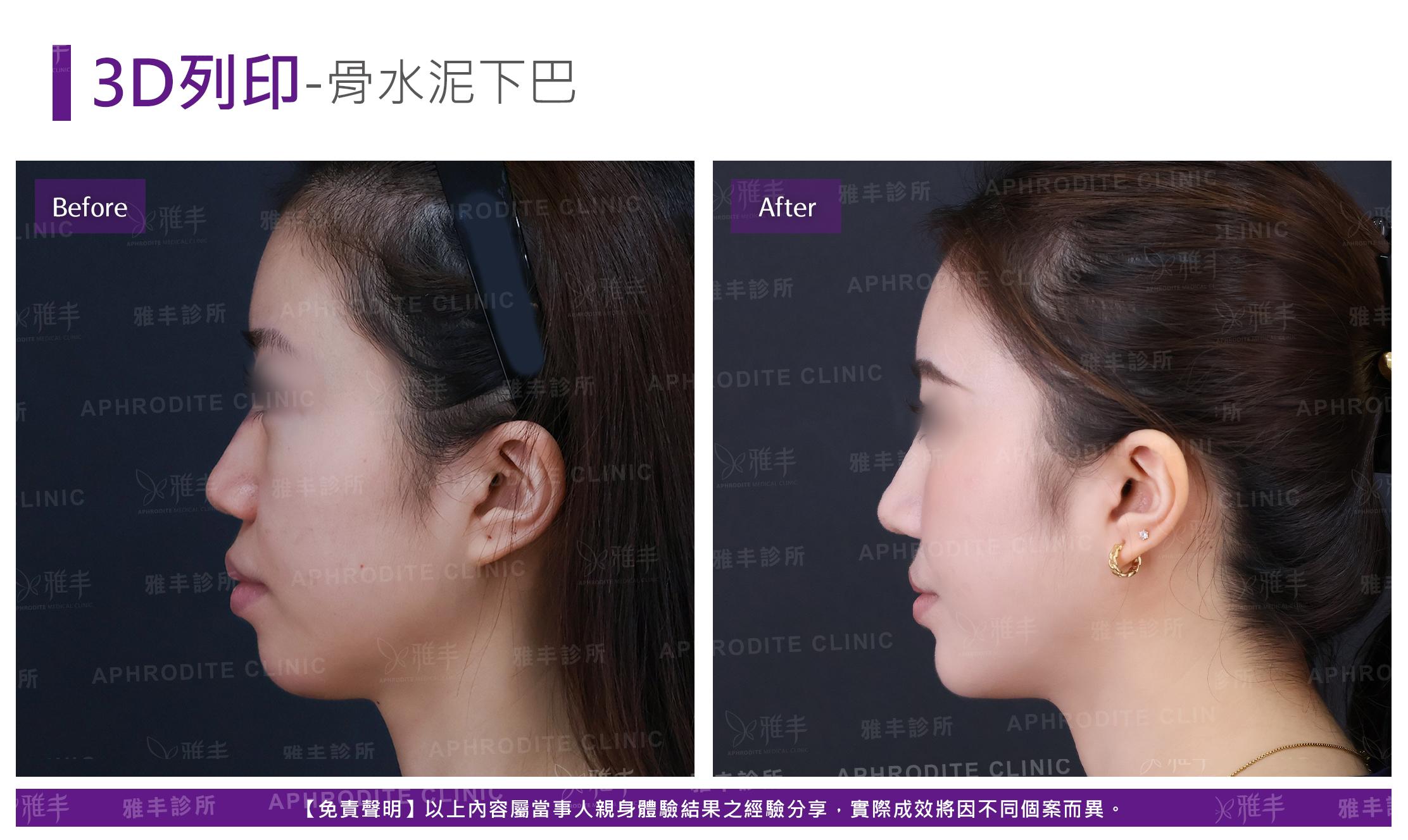 下巴手術-case5-L90.jpg