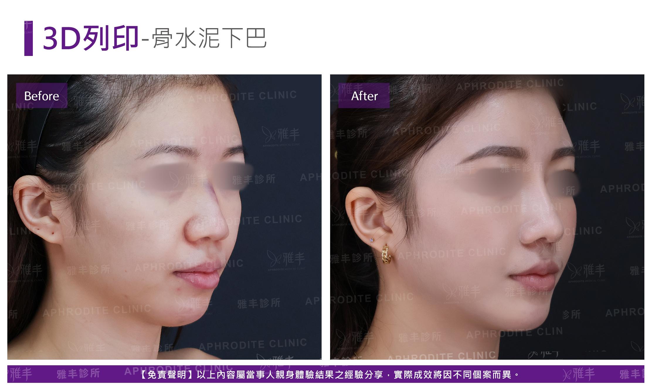下巴手術-case5-R45.jpg