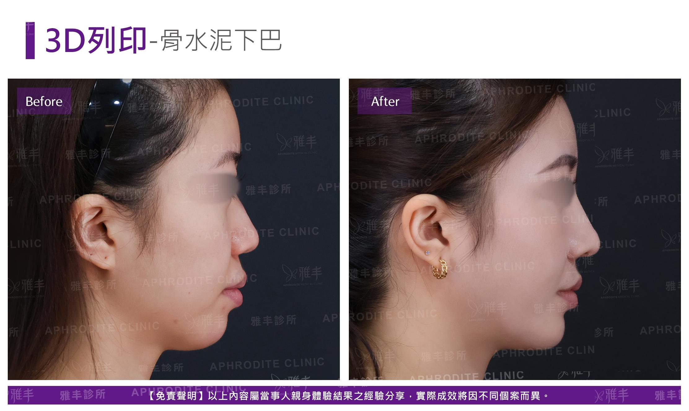 下巴手術-case5-R90.jpg