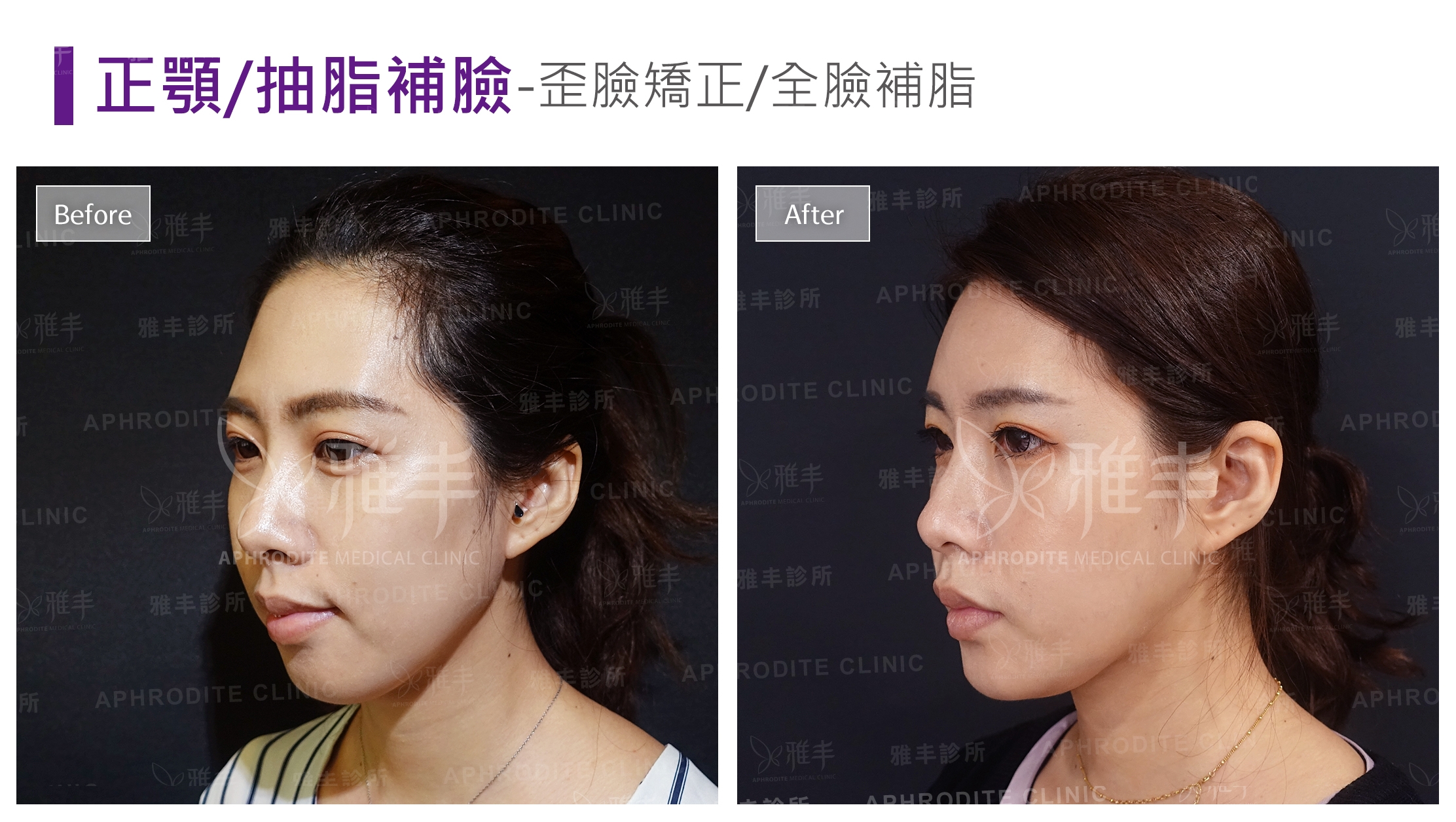 正顎/抽脂補臉-歪臉矯正/全臉補脂(Case6-L45)