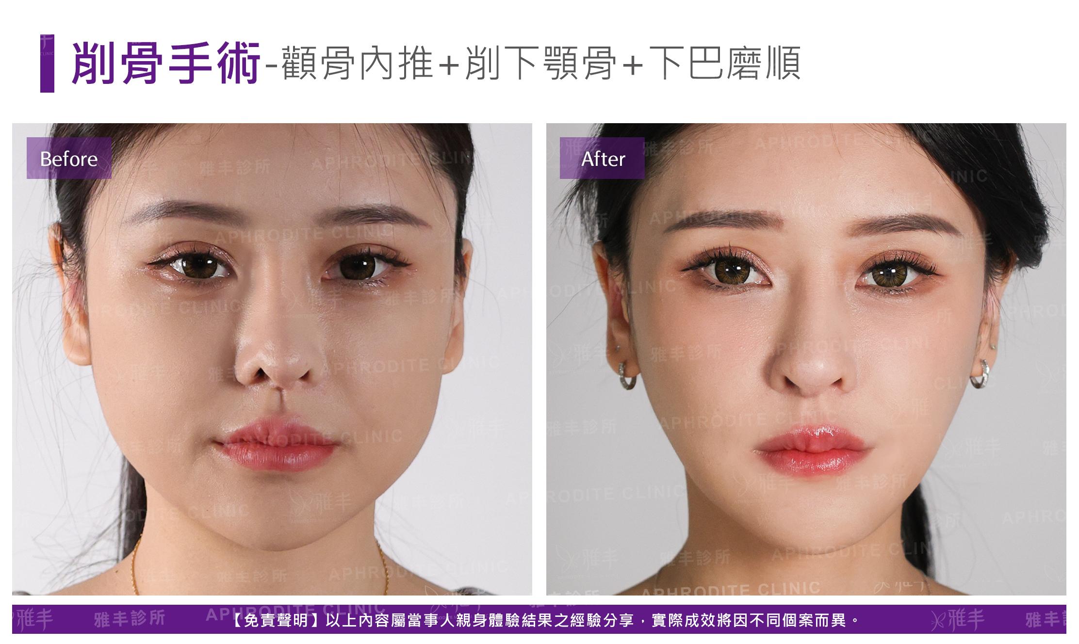 削骨手術-case11-F.jpg