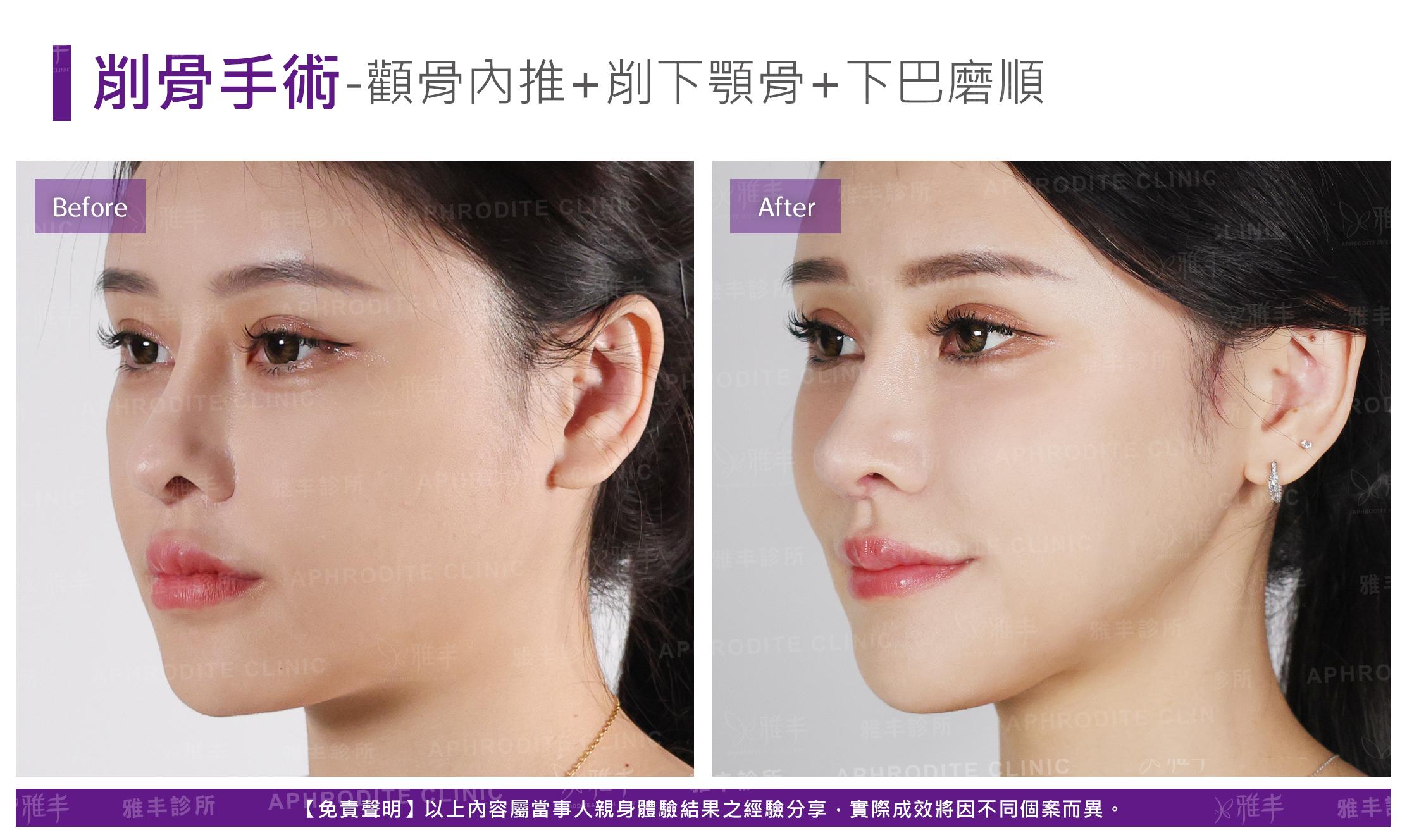 削骨手術-case11-L45.jpg