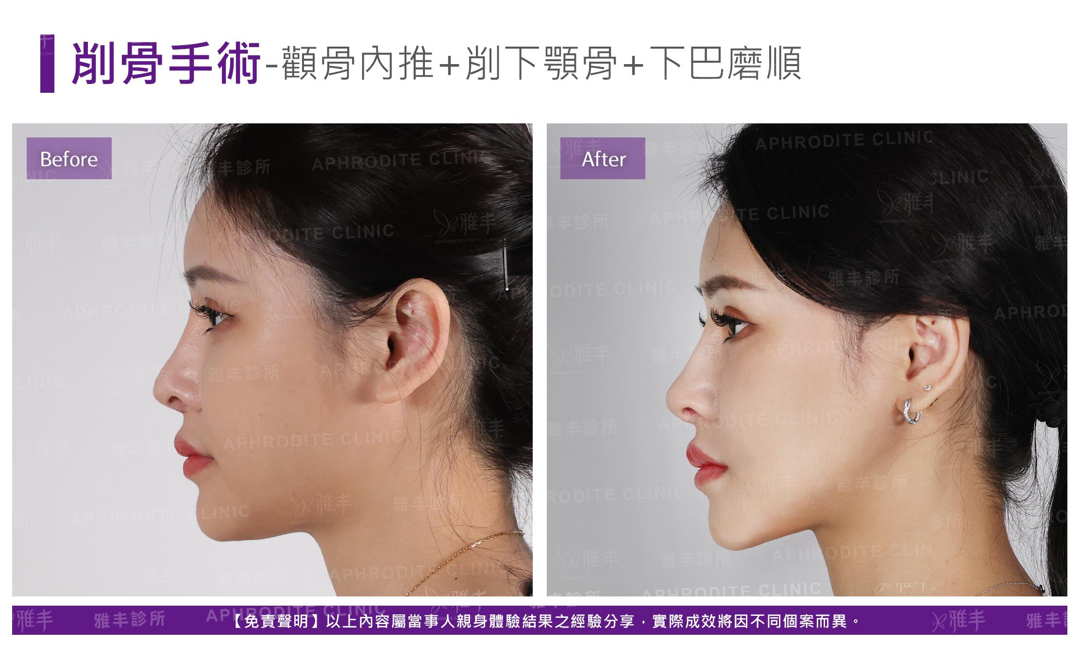 削骨手術-case11-L90.jpg