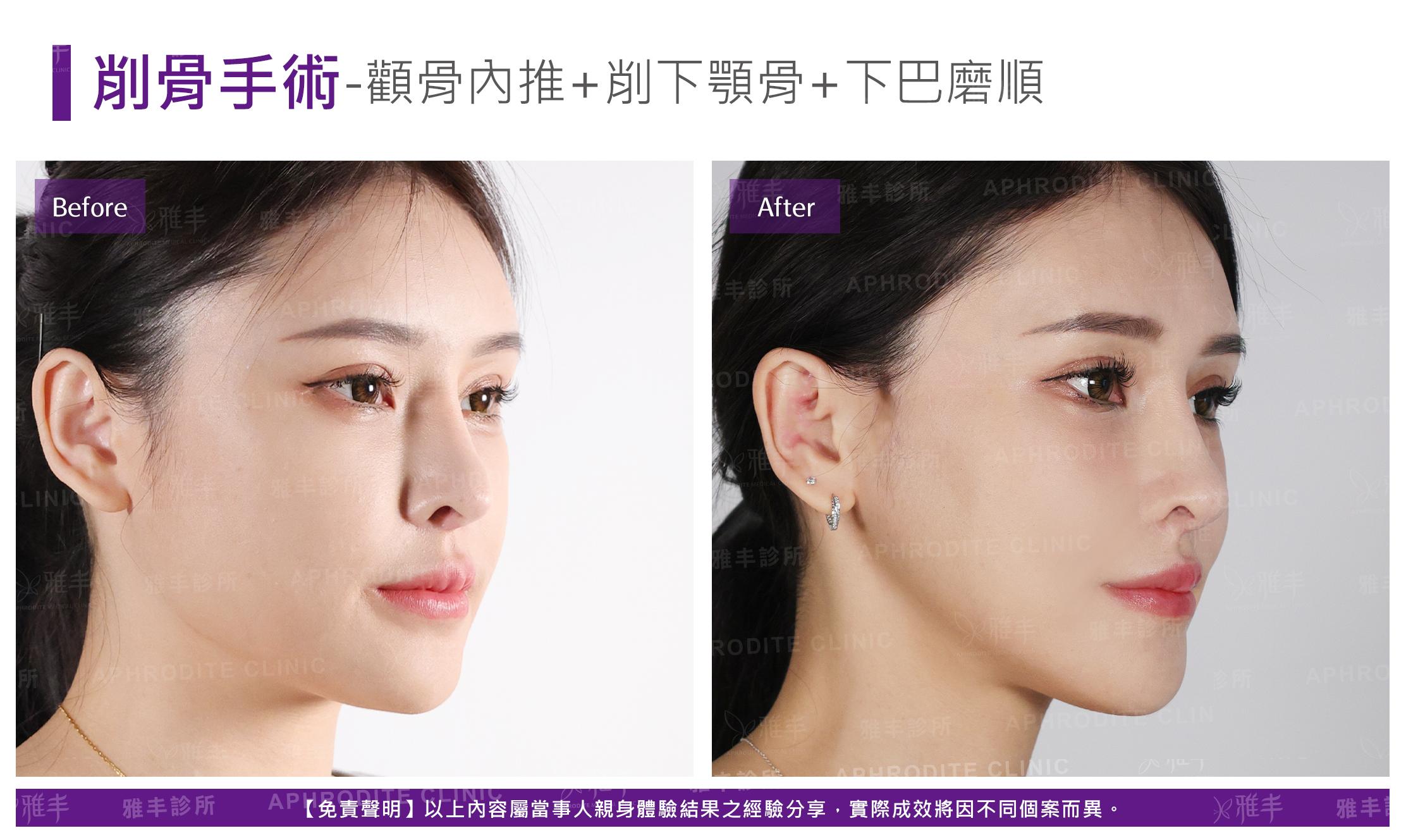 削骨手術-case11-R45.jpg