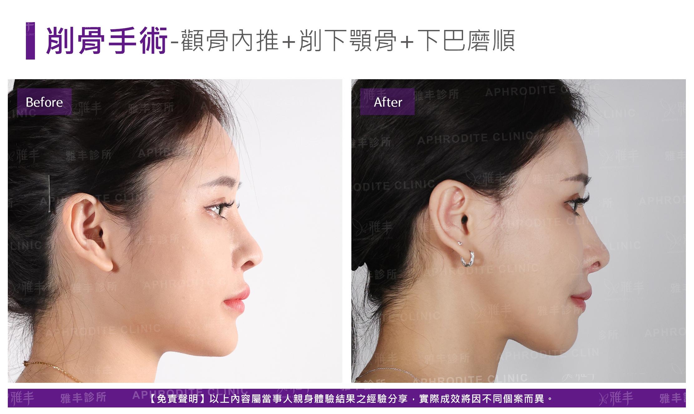 削骨手術-case11-R90.jpg