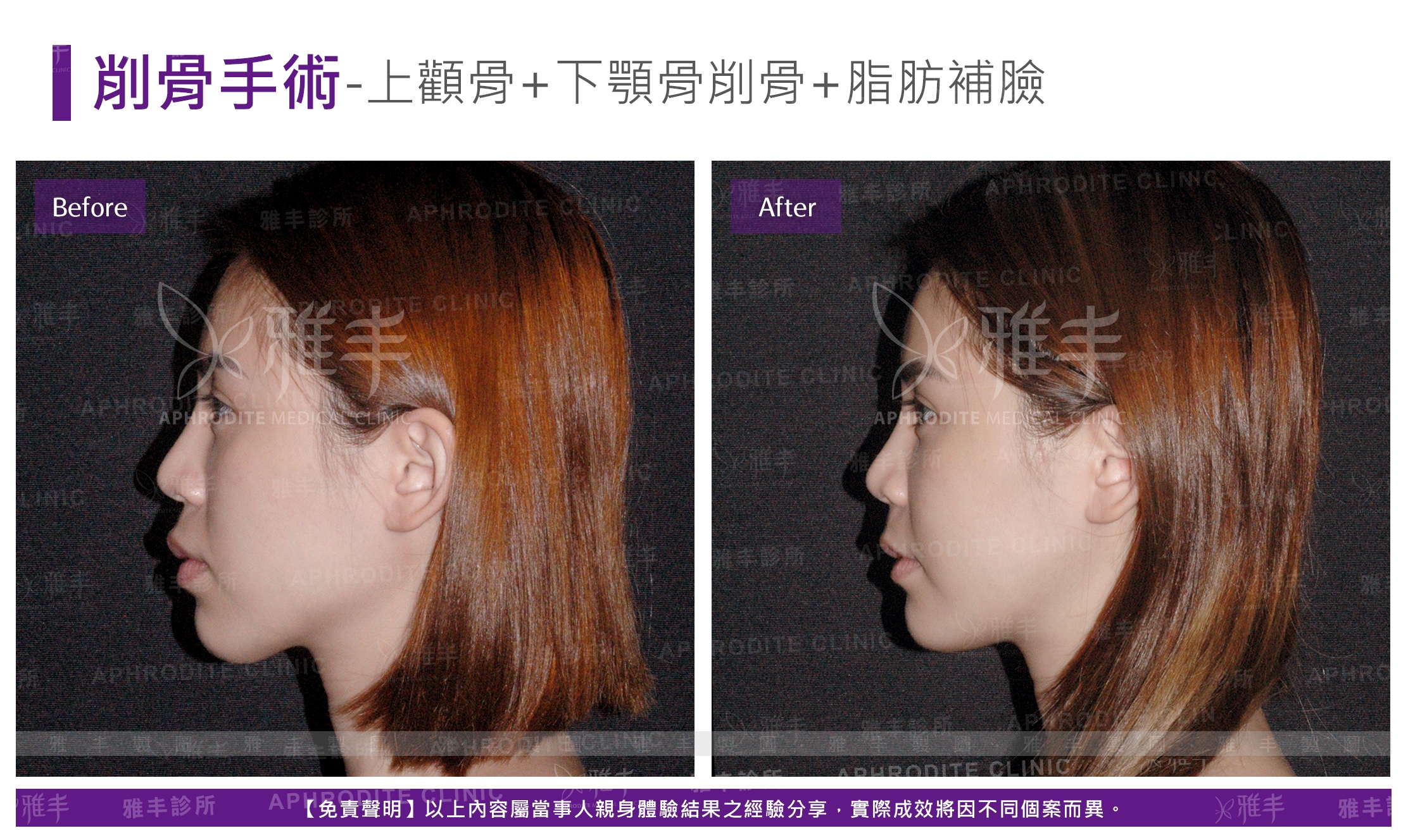 削骨手術-上顴骨+下顎骨削骨+脂肪補臉(Case6-L90)