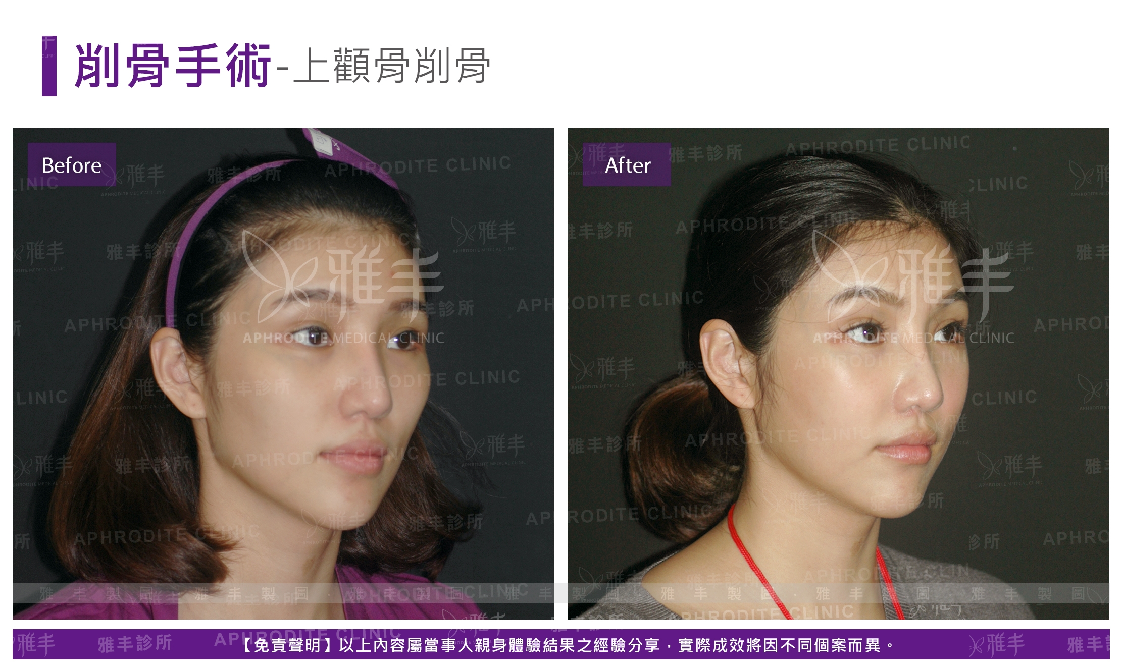 削骨手術-上顴骨削骨(Case7-R45)