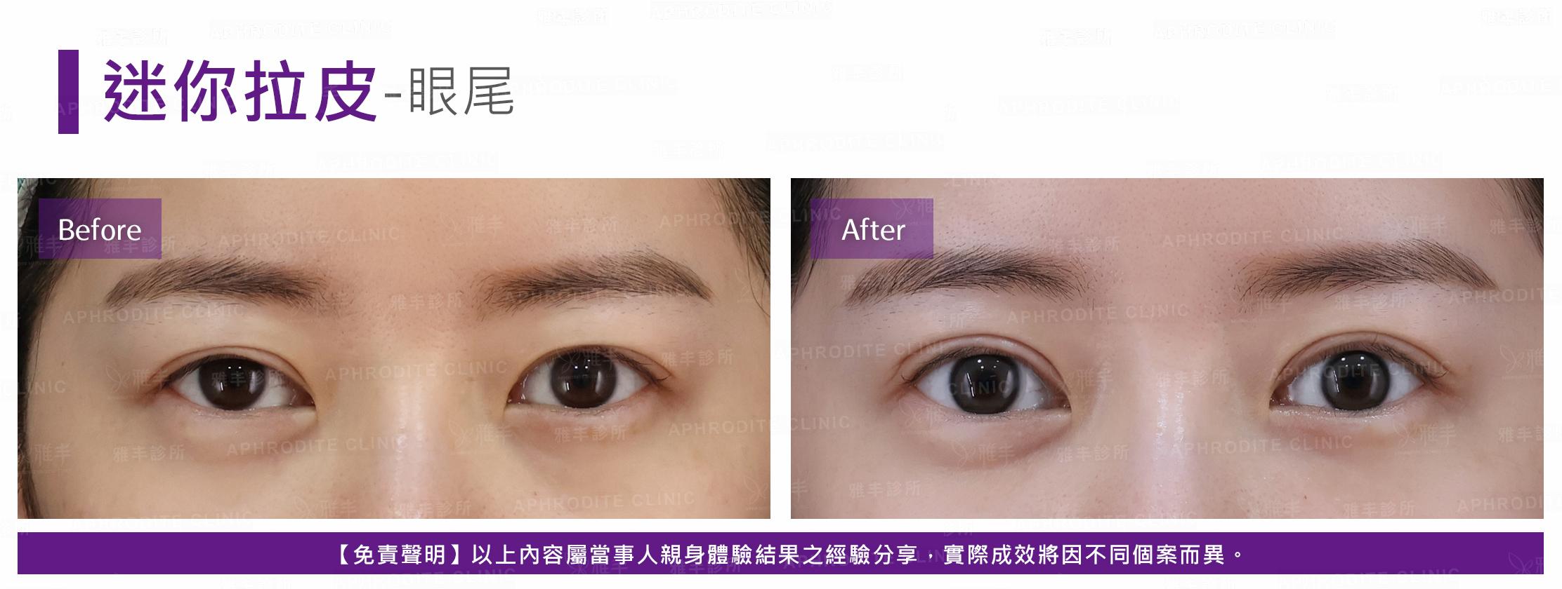 迷你拉皮-case8-F.jpg
