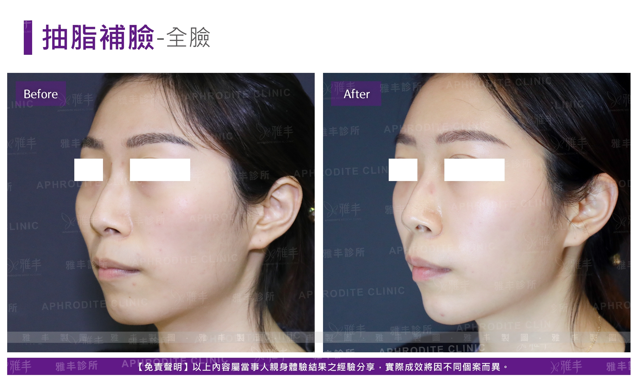 抽脂補臉-全臉(Case12-L45)