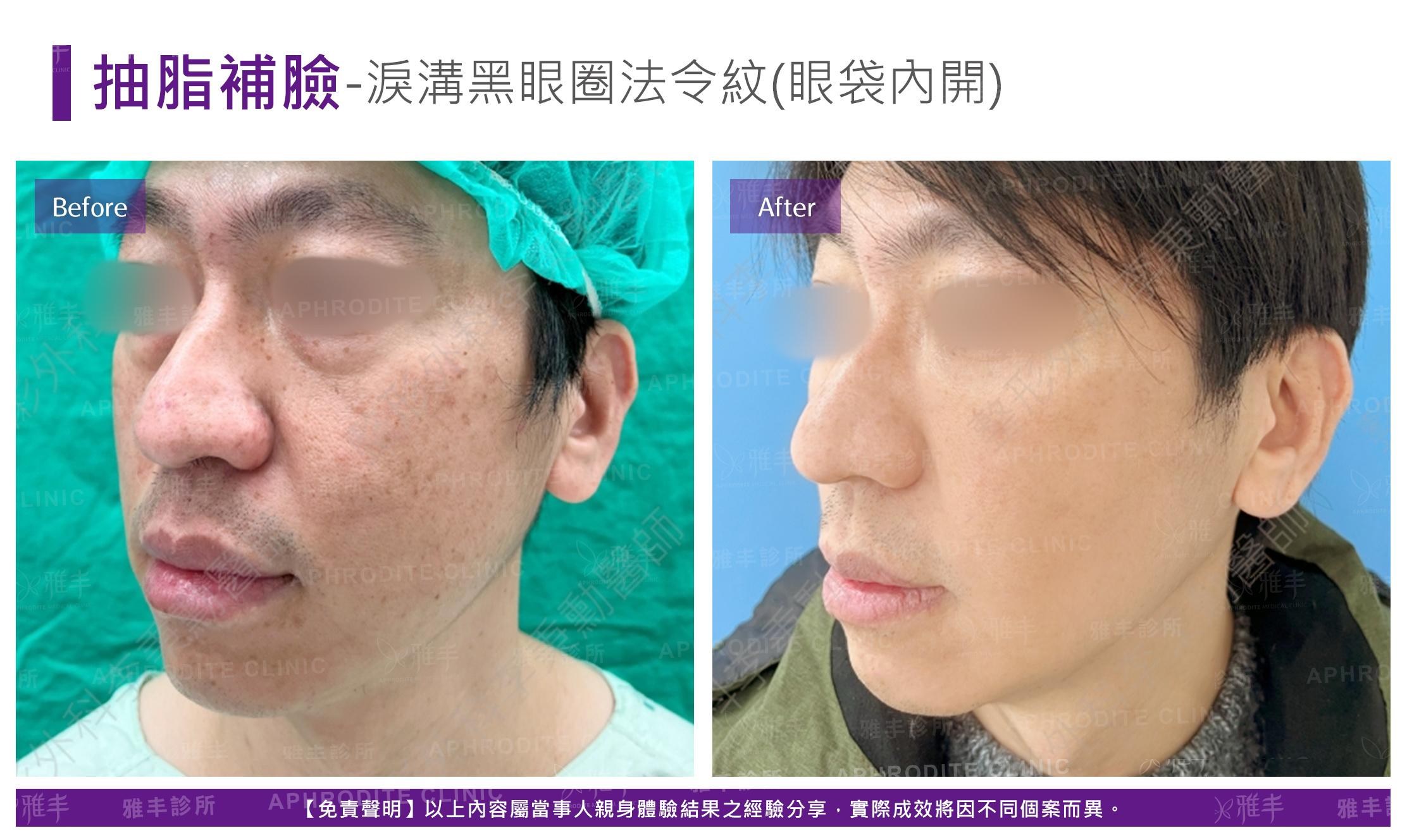 抽脂補臉-case18-L45.jpg