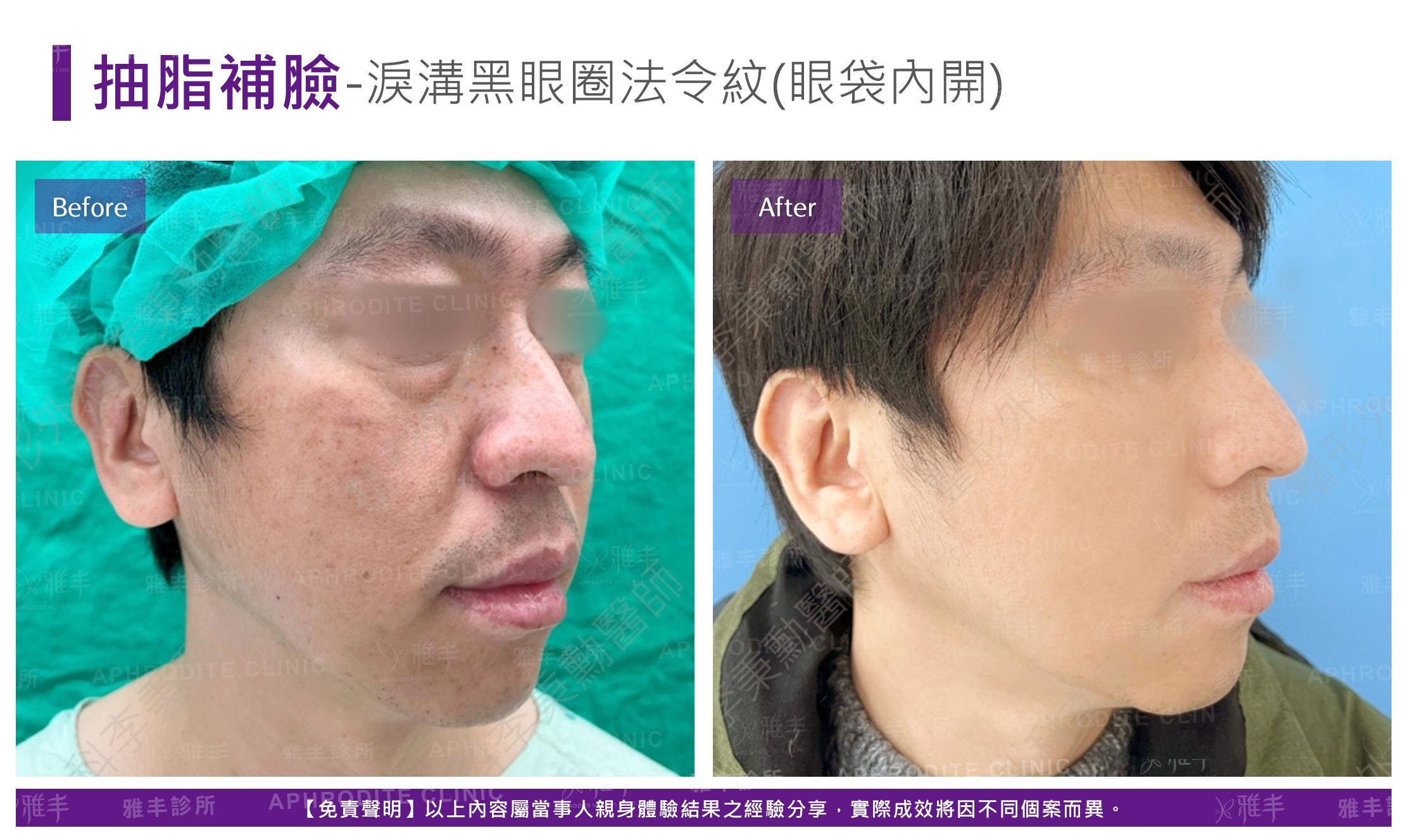 抽脂補臉-case18-R45.jpg