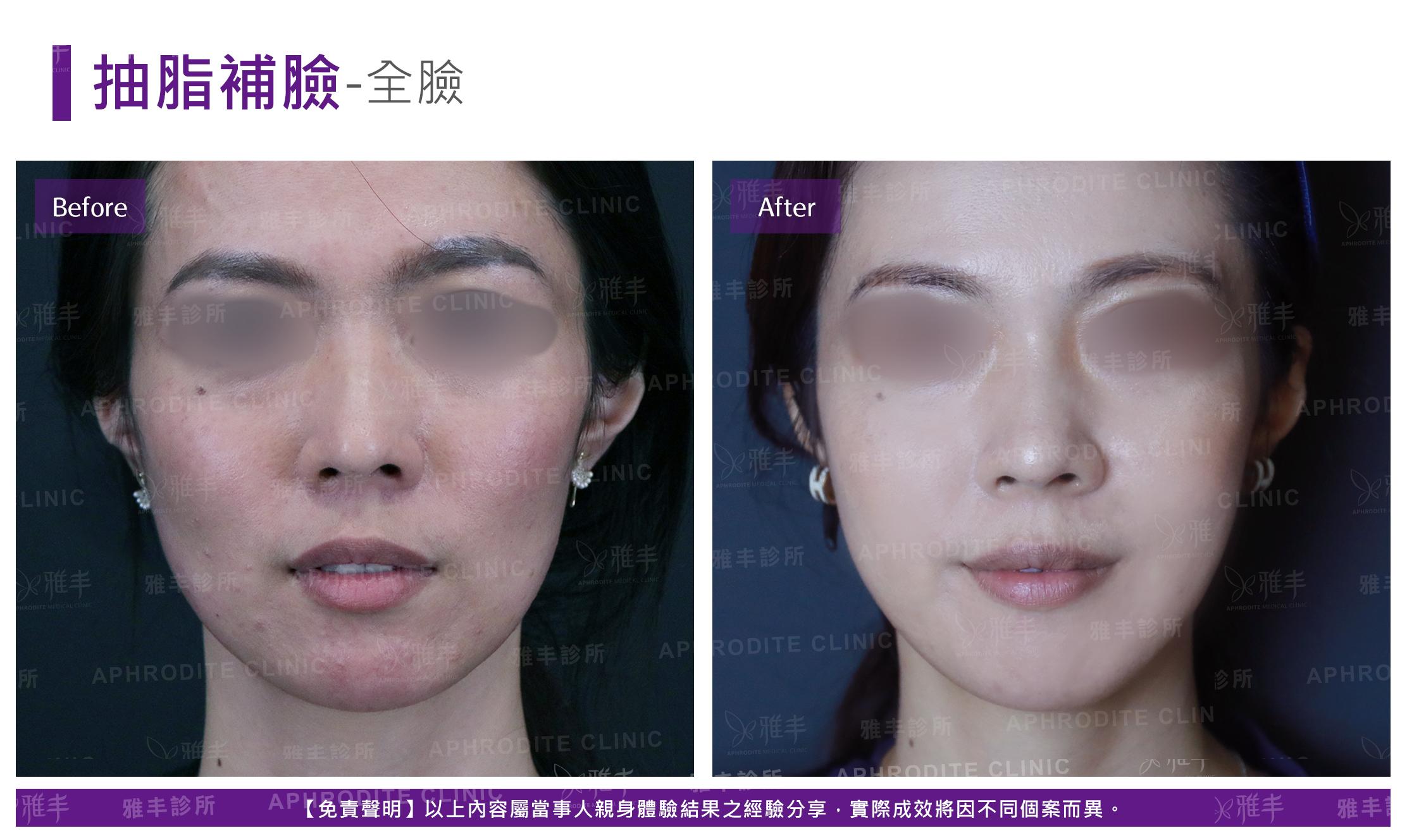 抽脂補臉-case19-F.jpg