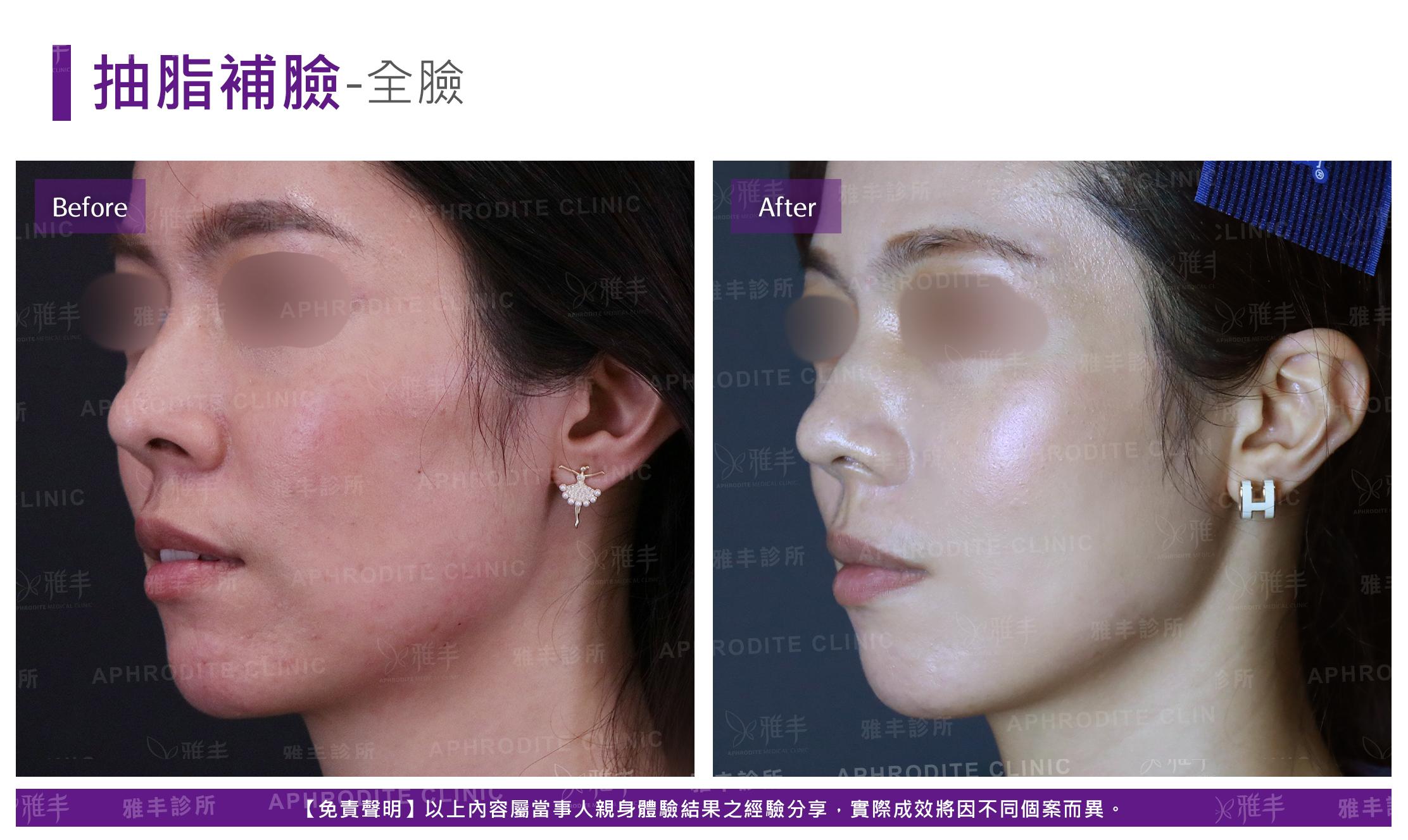 抽脂補臉-case19-L45.jpg