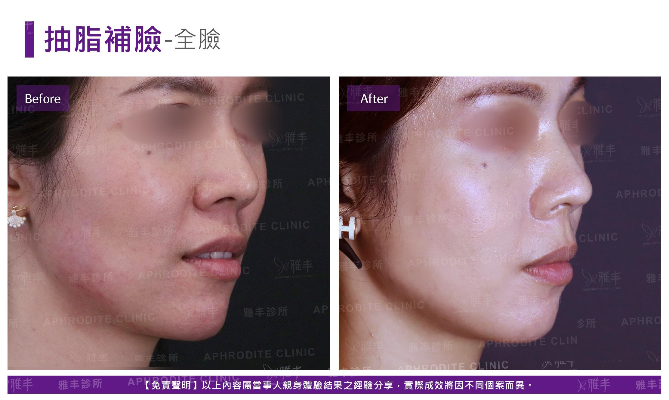 抽脂補臉-case19-R45.jpg