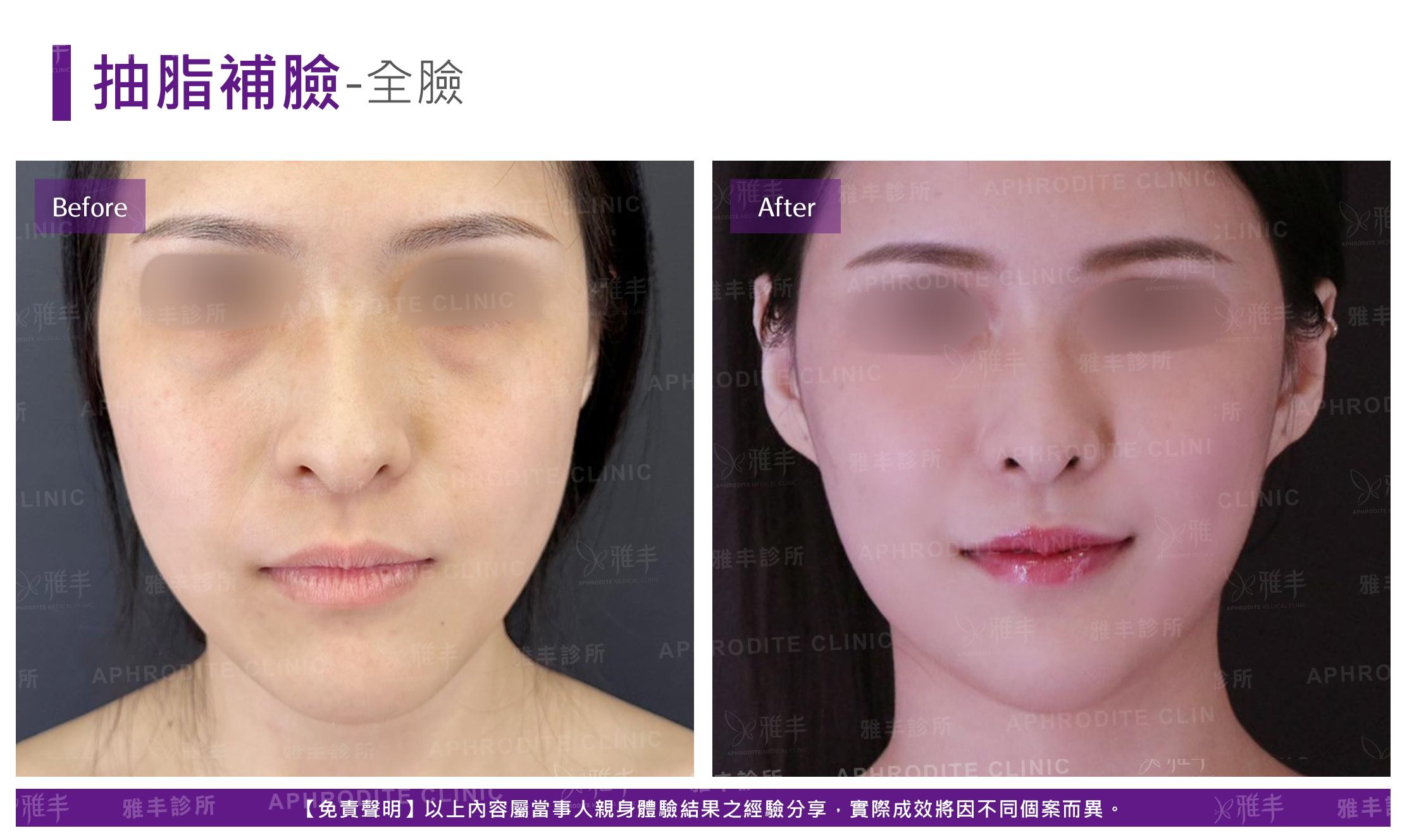抽脂補臉-case21-F.jpg