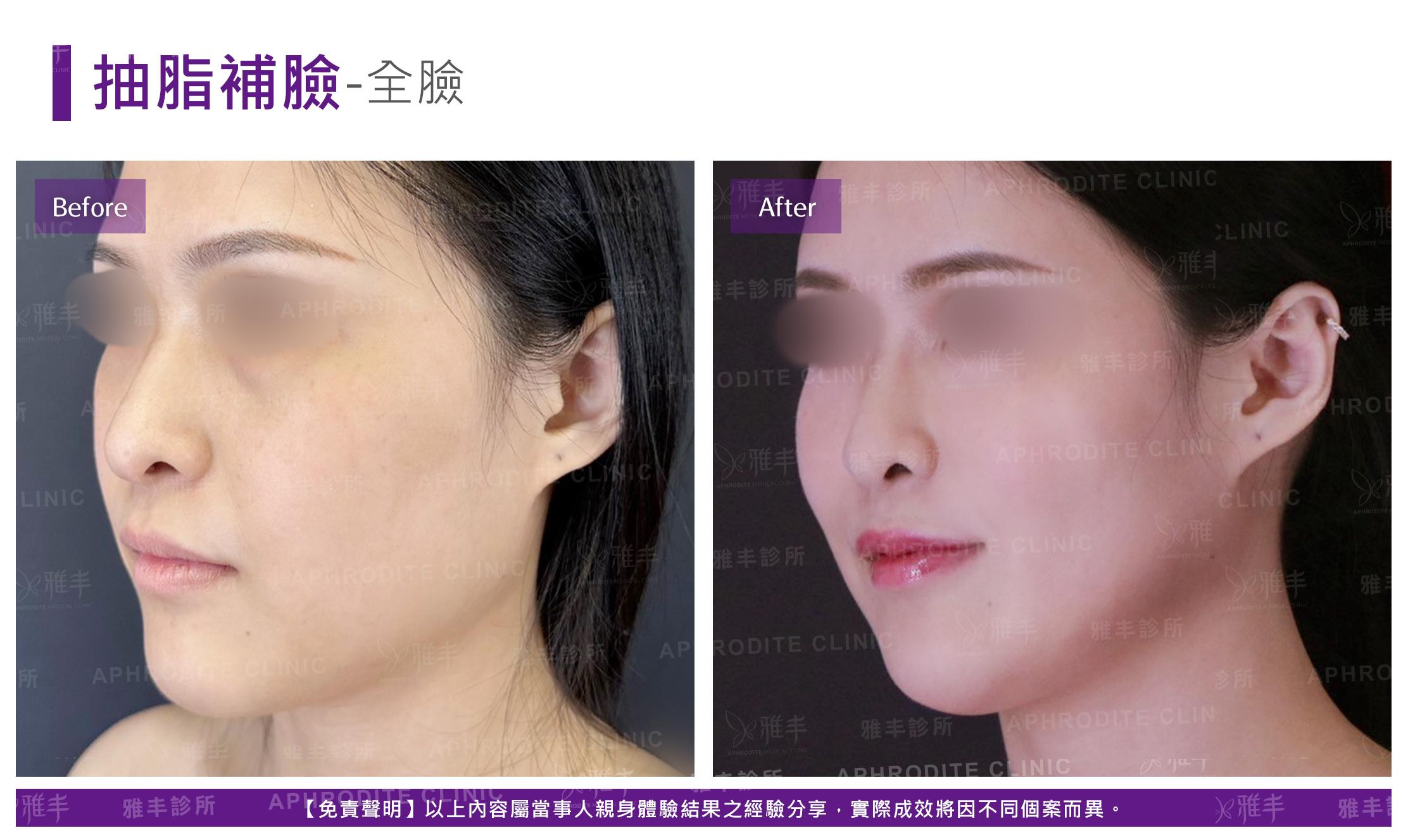 抽脂補臉-case21-L45.jpg