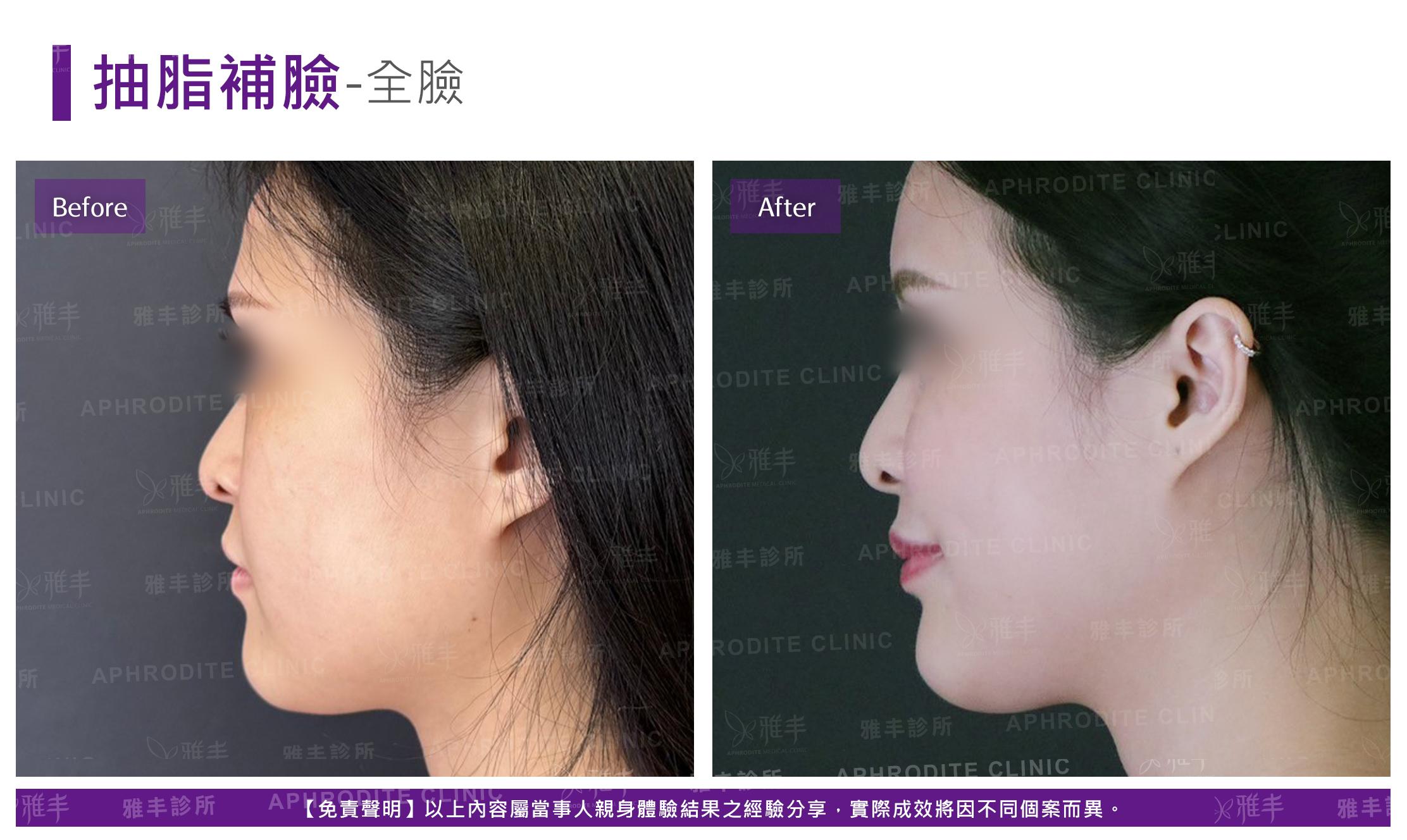 抽脂補臉-case21-L90.jpg