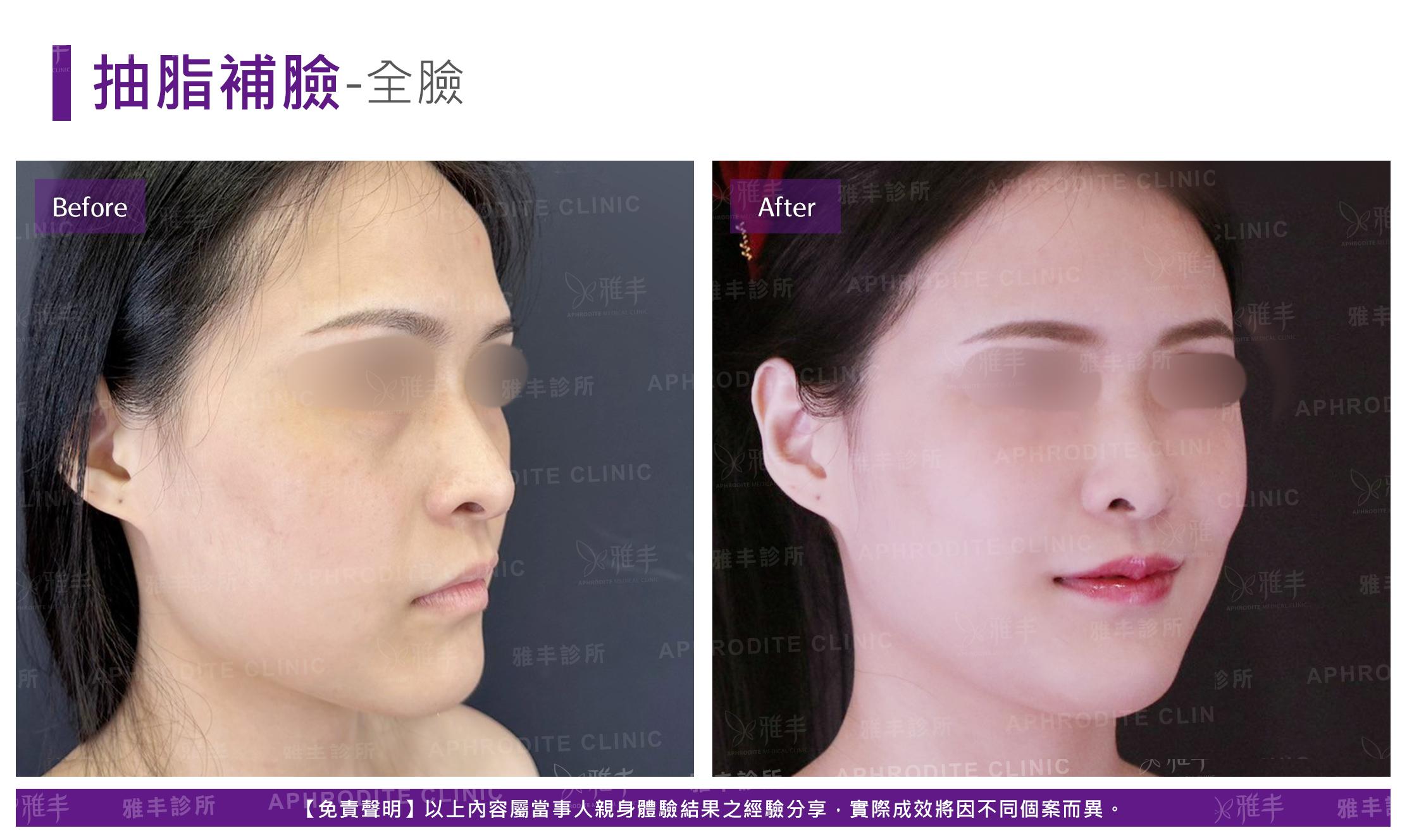 抽脂補臉-case21-R45.jpg