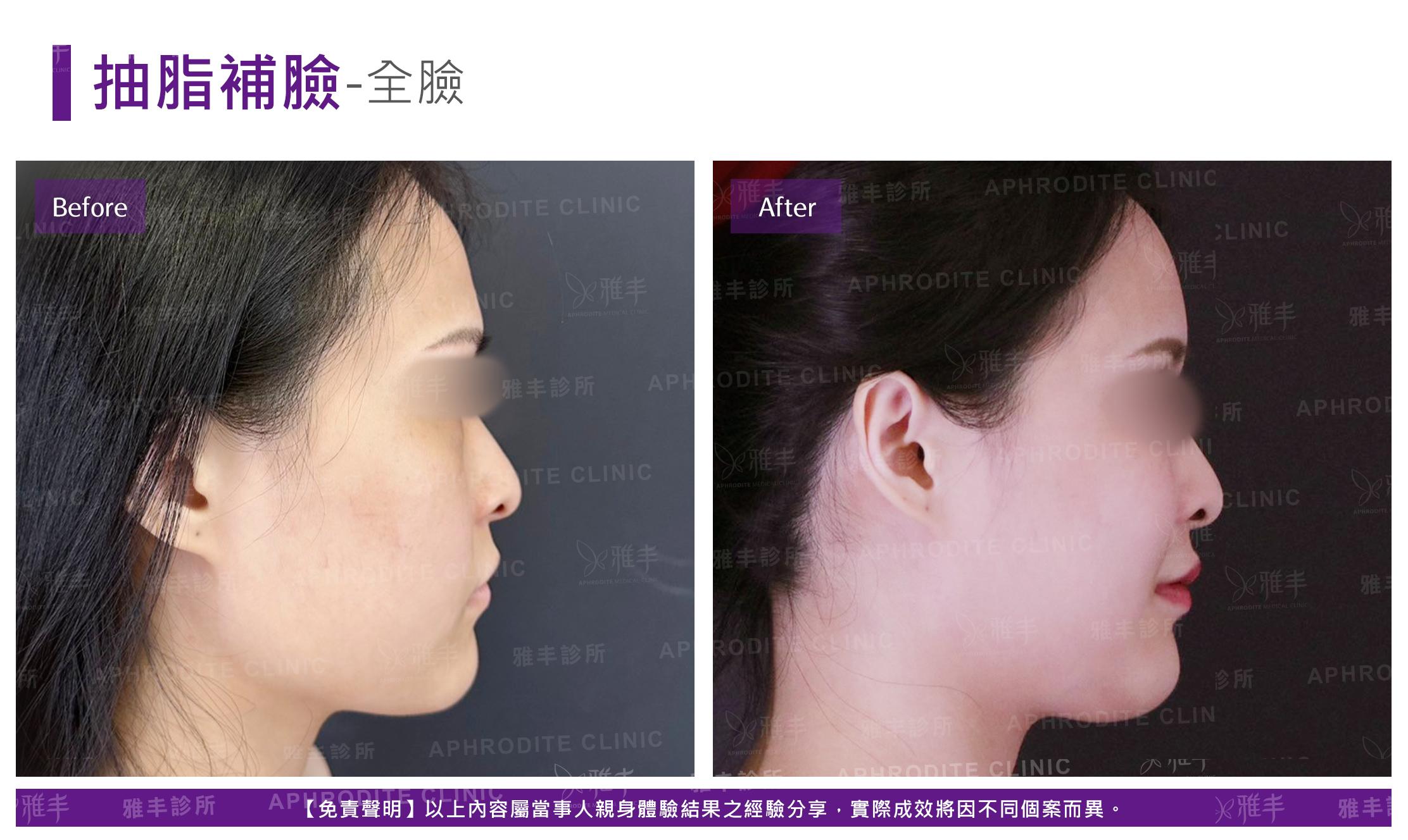 抽脂補臉-case21-R90.jpg