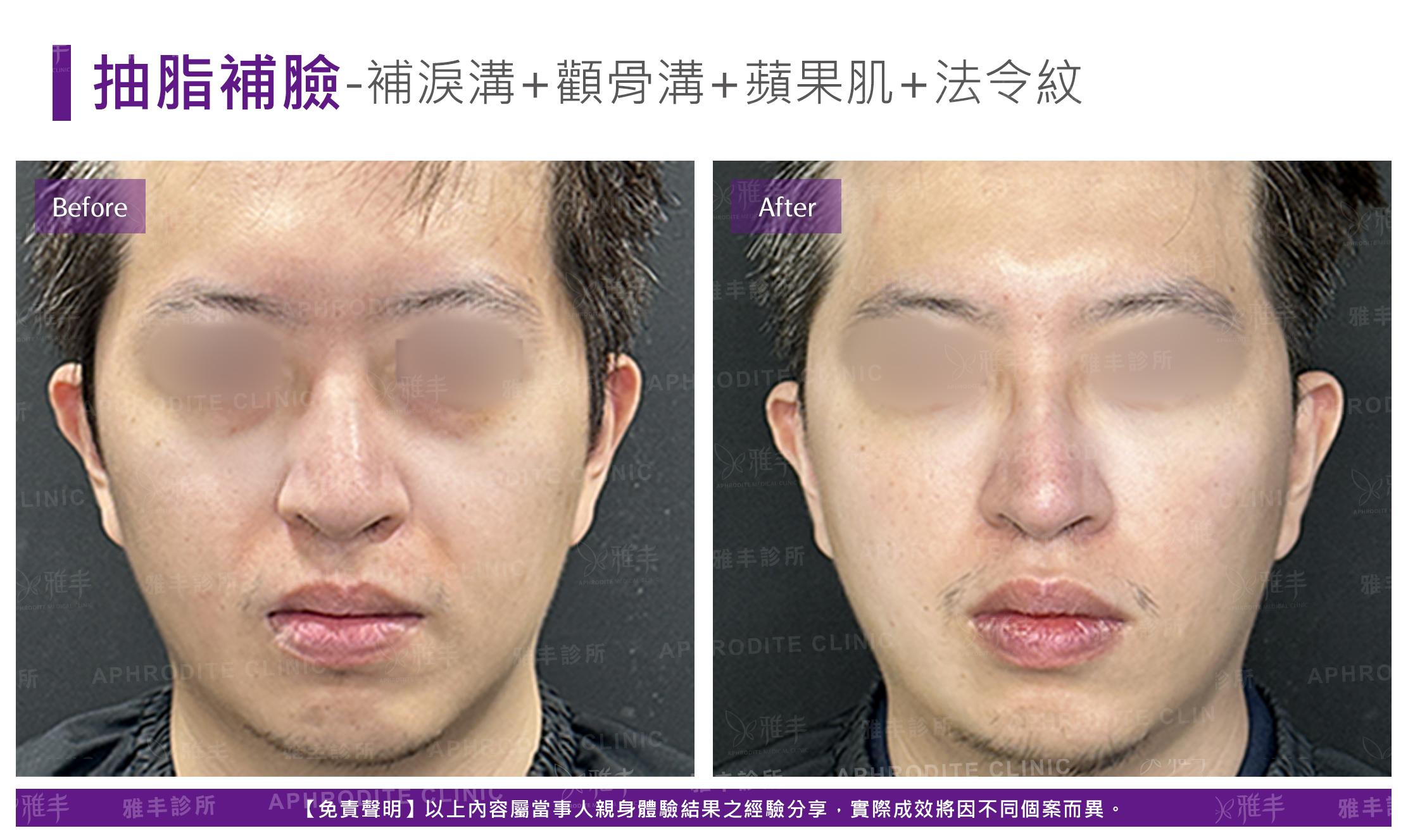 抽脂補臉-case22-F.jpg