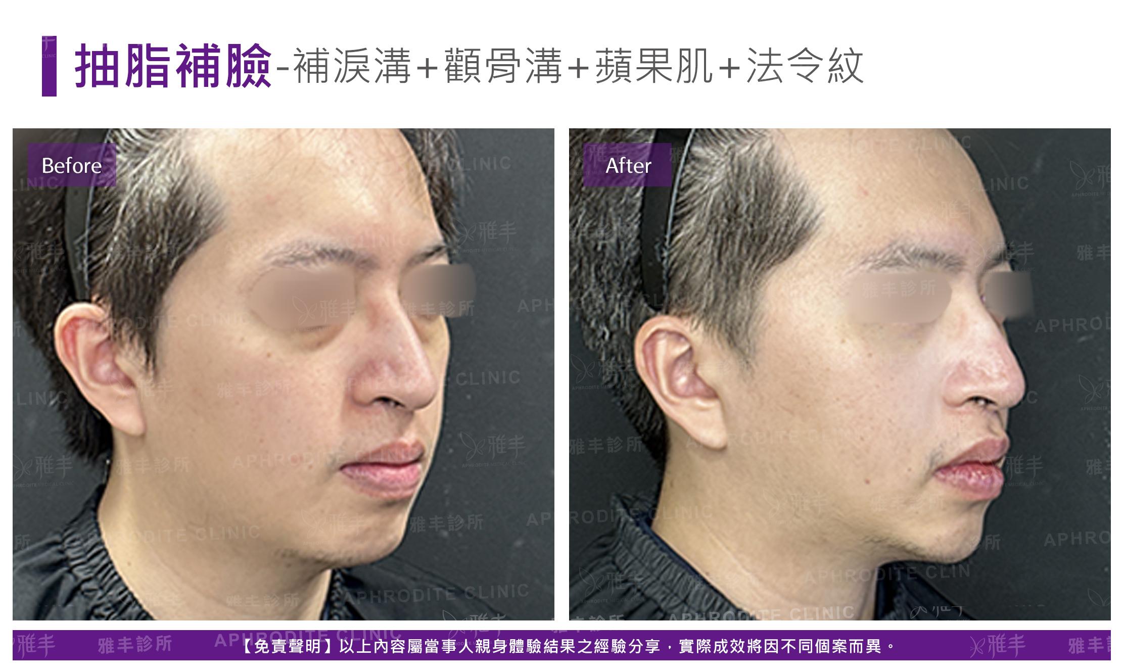 抽脂補臉-case22-R45