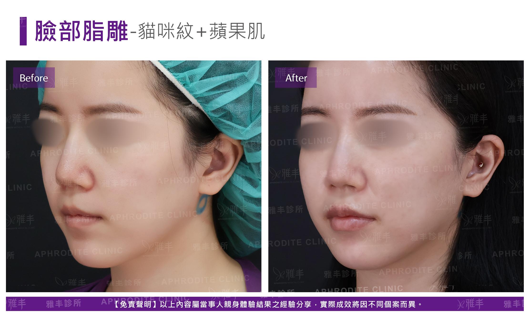 臉部脂雕-case24-L45.jpg