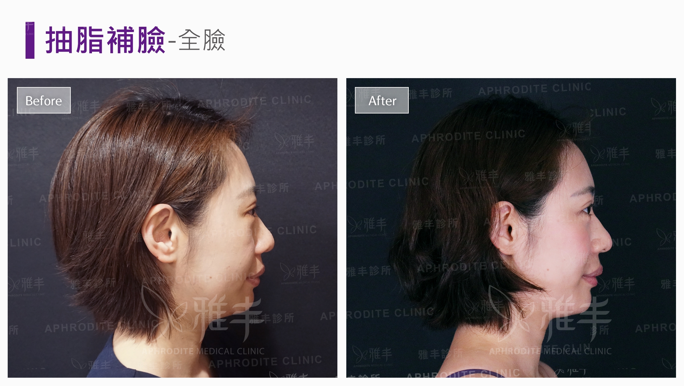 抽脂補臉-全臉(Case3-R90)