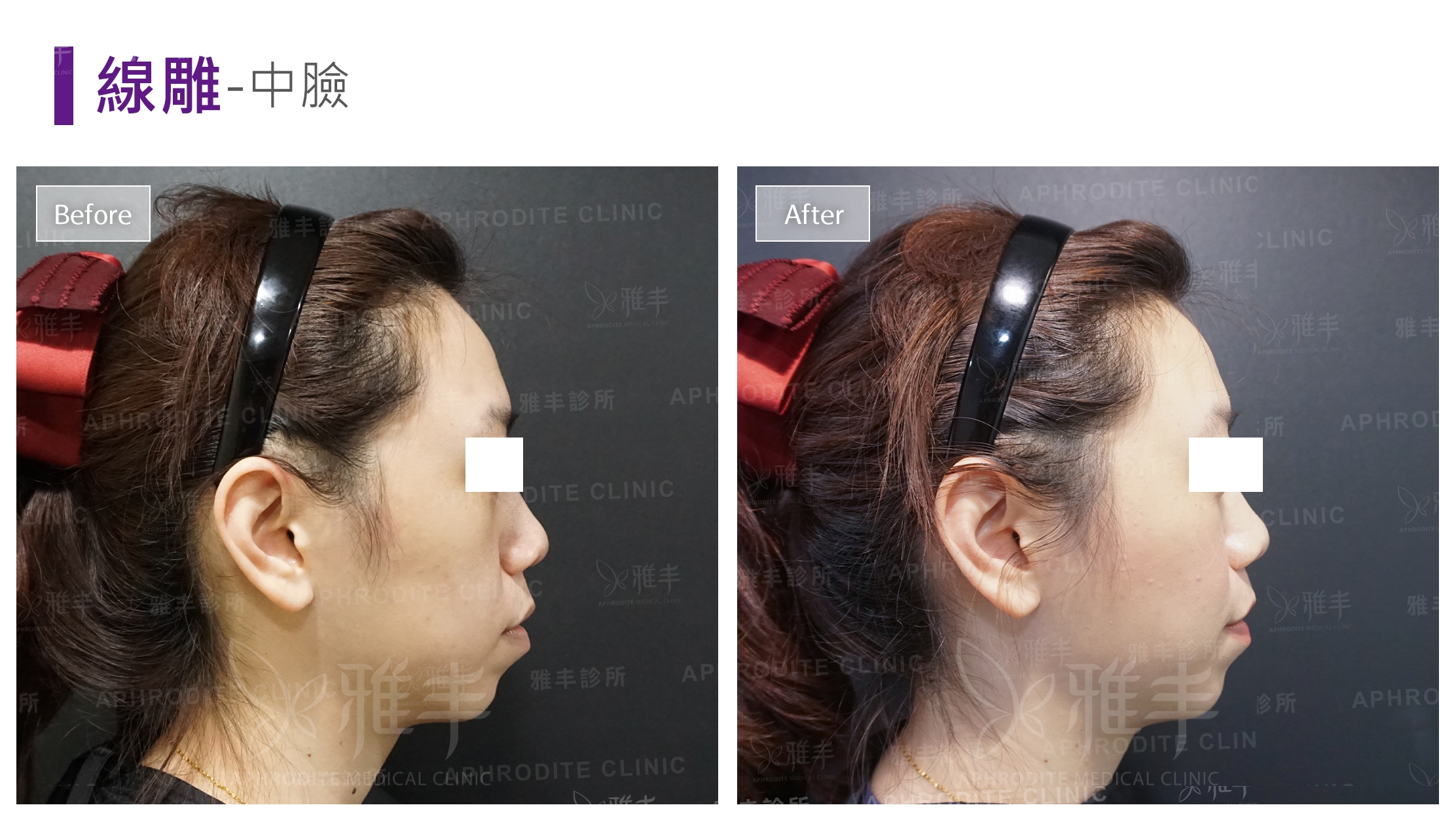 線雕-中臉(Case1-R90)