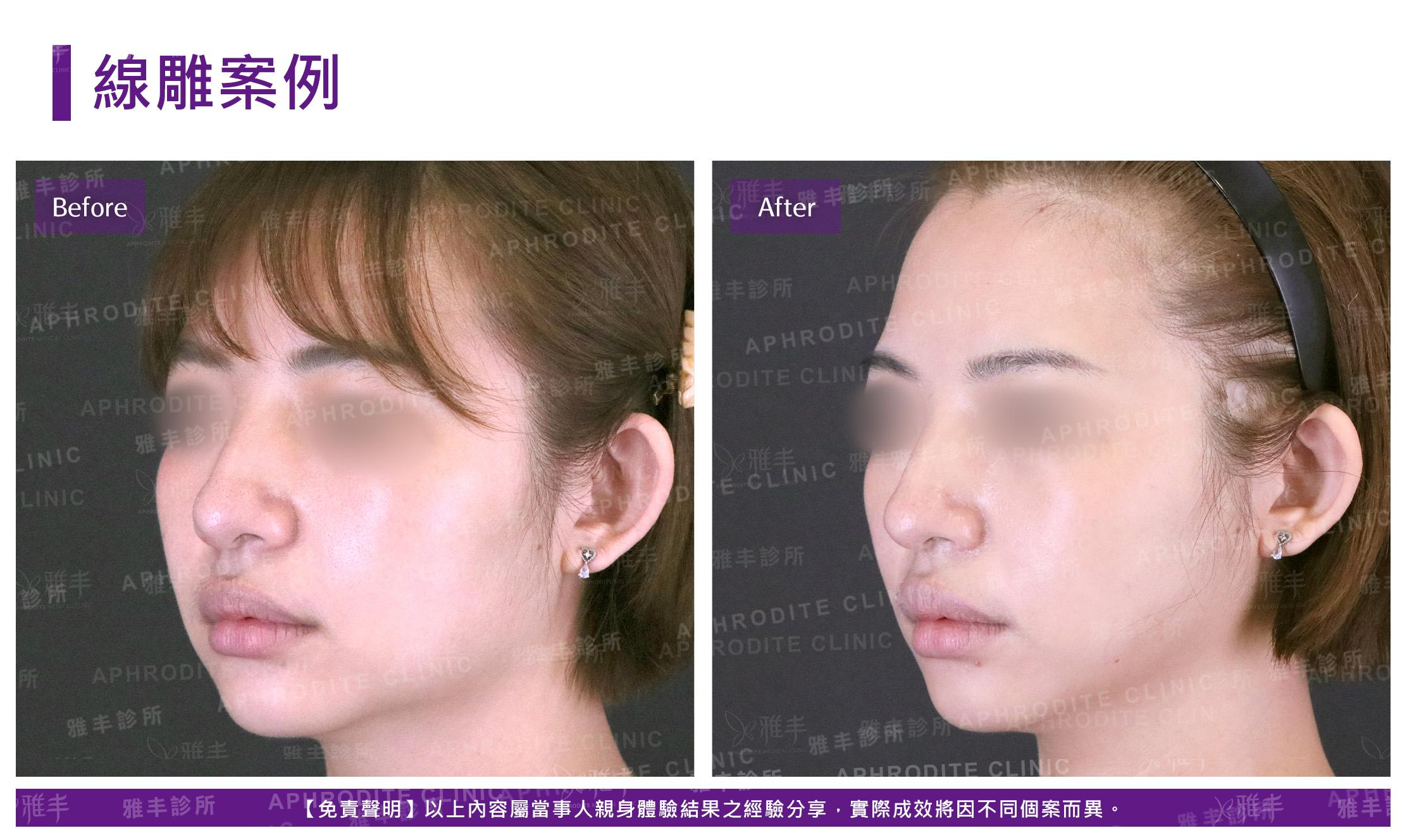 線雕案例-case10-L45