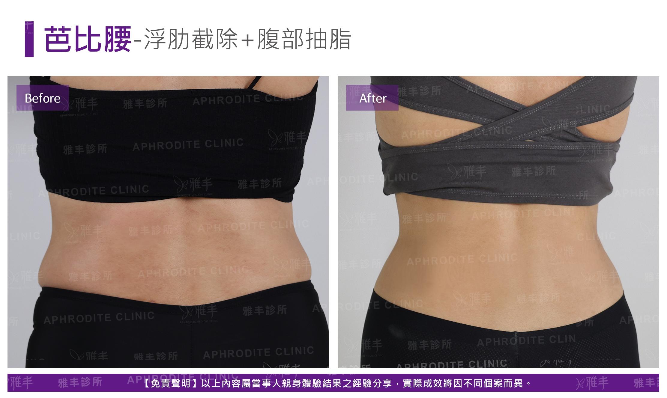 芭比腰-case1-B.jpg