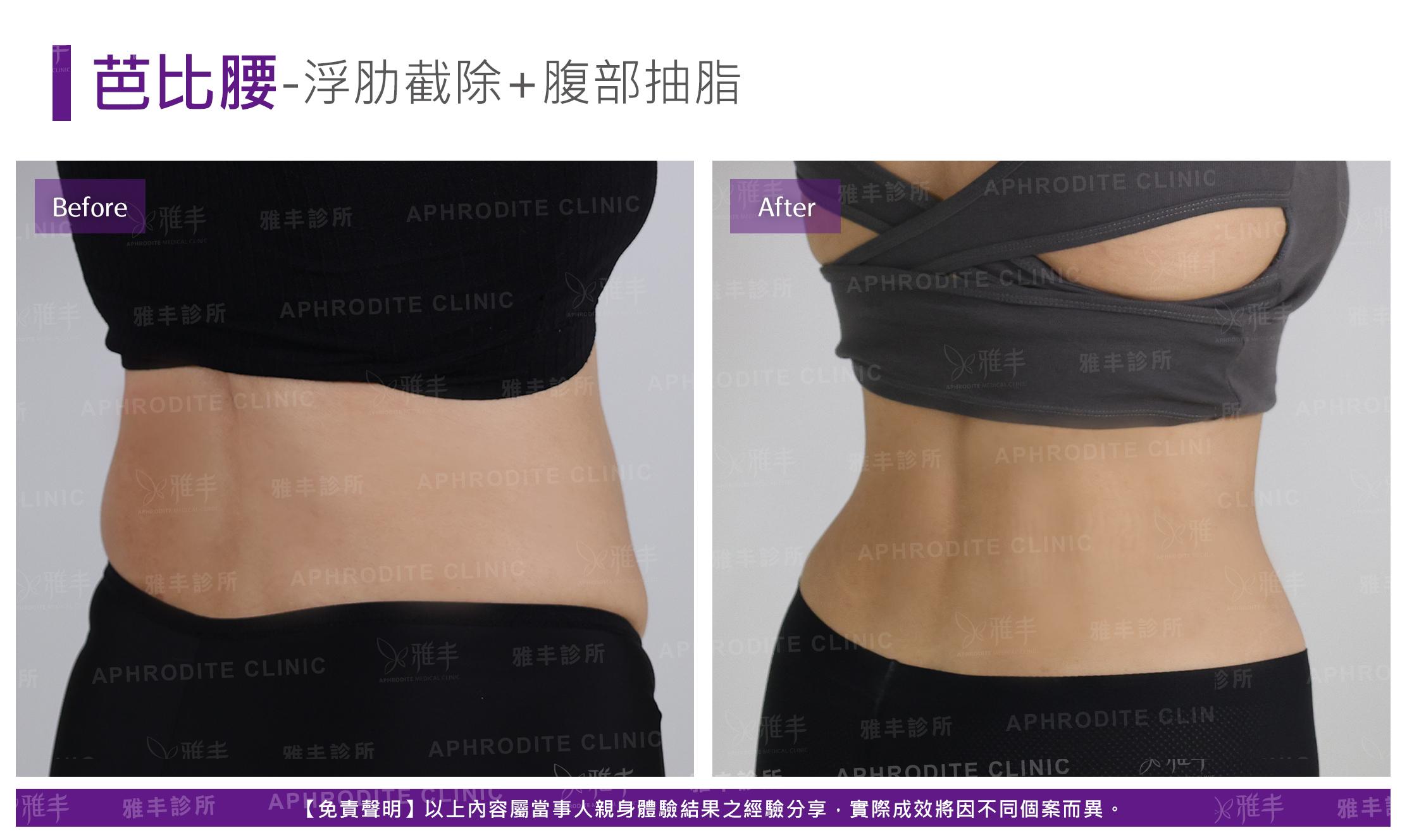 芭比腰-case1-BR45.jpg