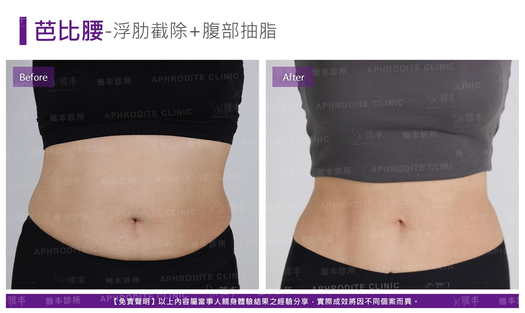 芭比腰-case1-F.jpg