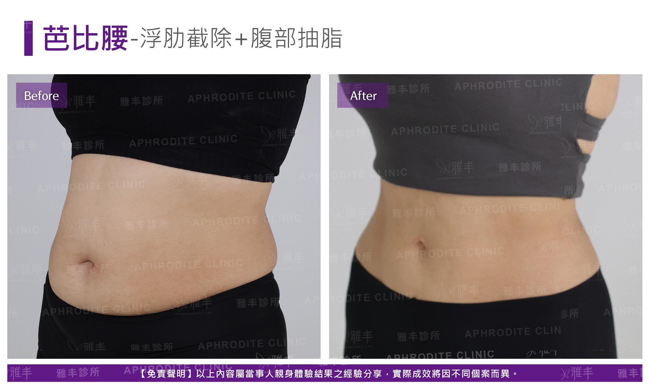 芭比腰-case1-L45.jpg