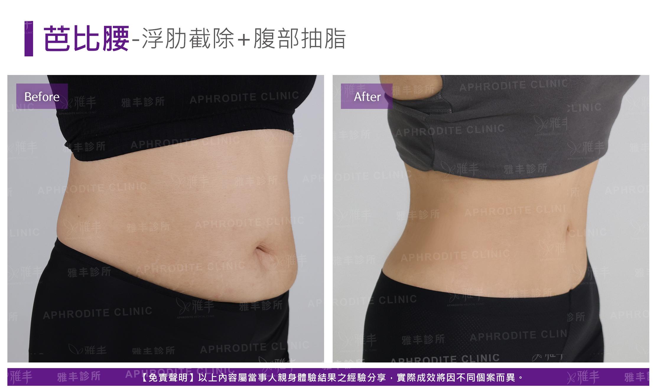 芭比腰-case1-R45.jpg